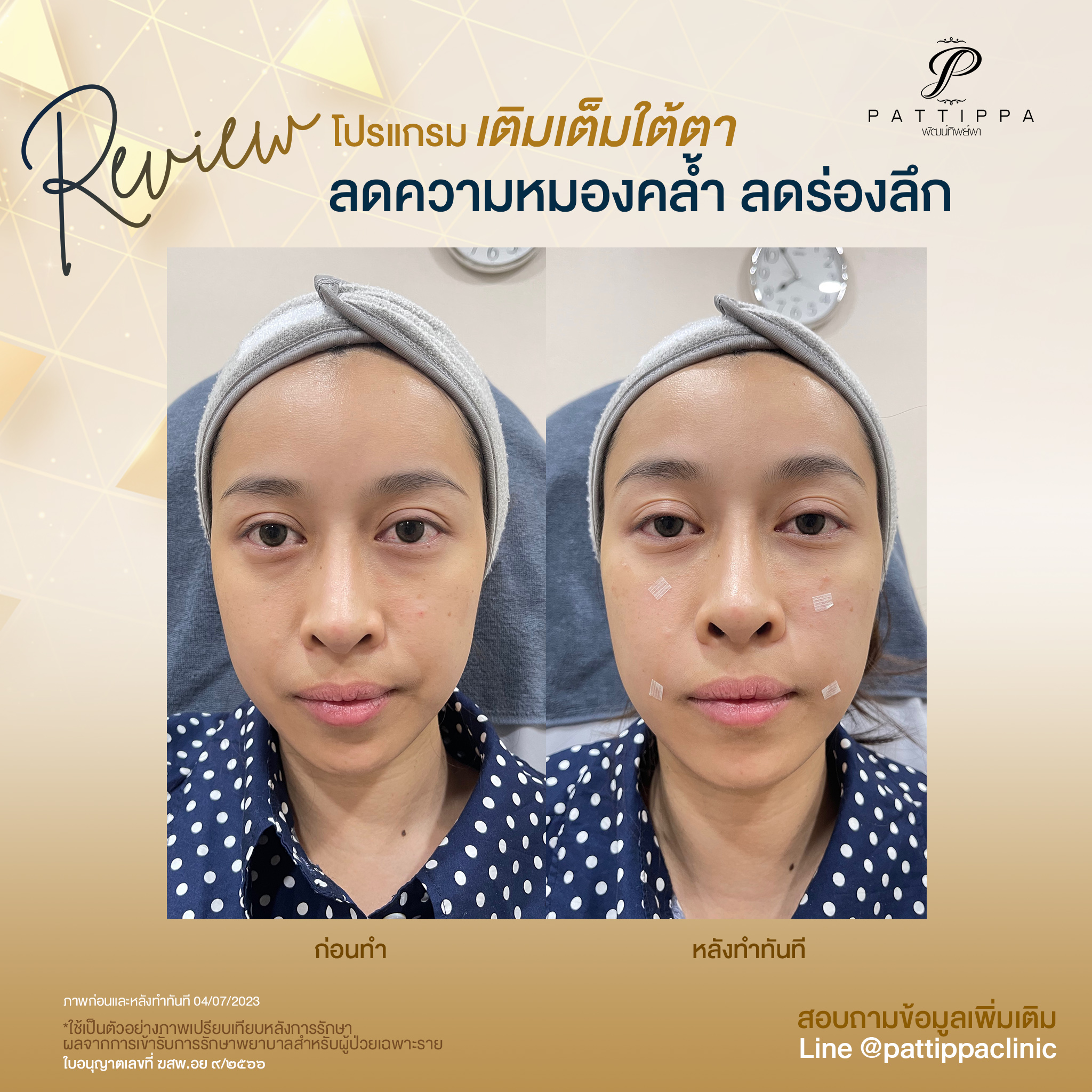 Patt_review_filler-eye_001