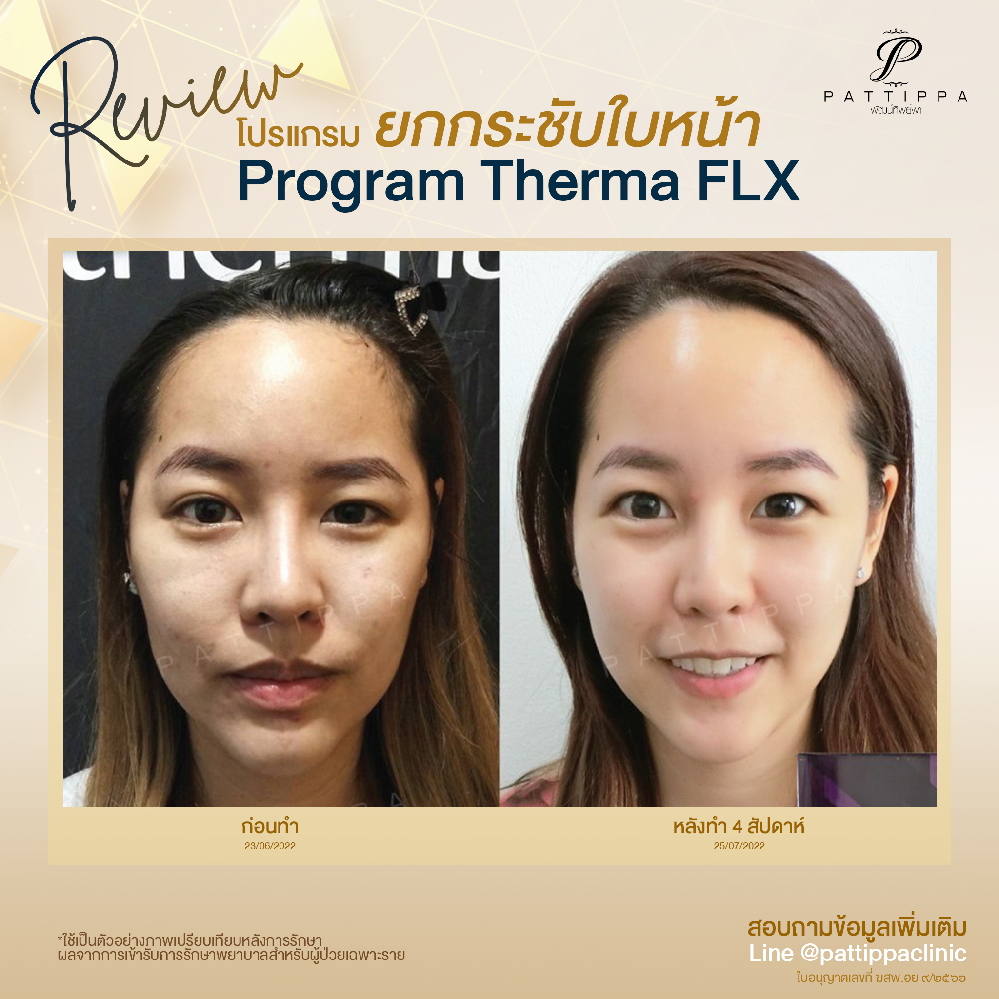 Patt_review_thermage_001-1