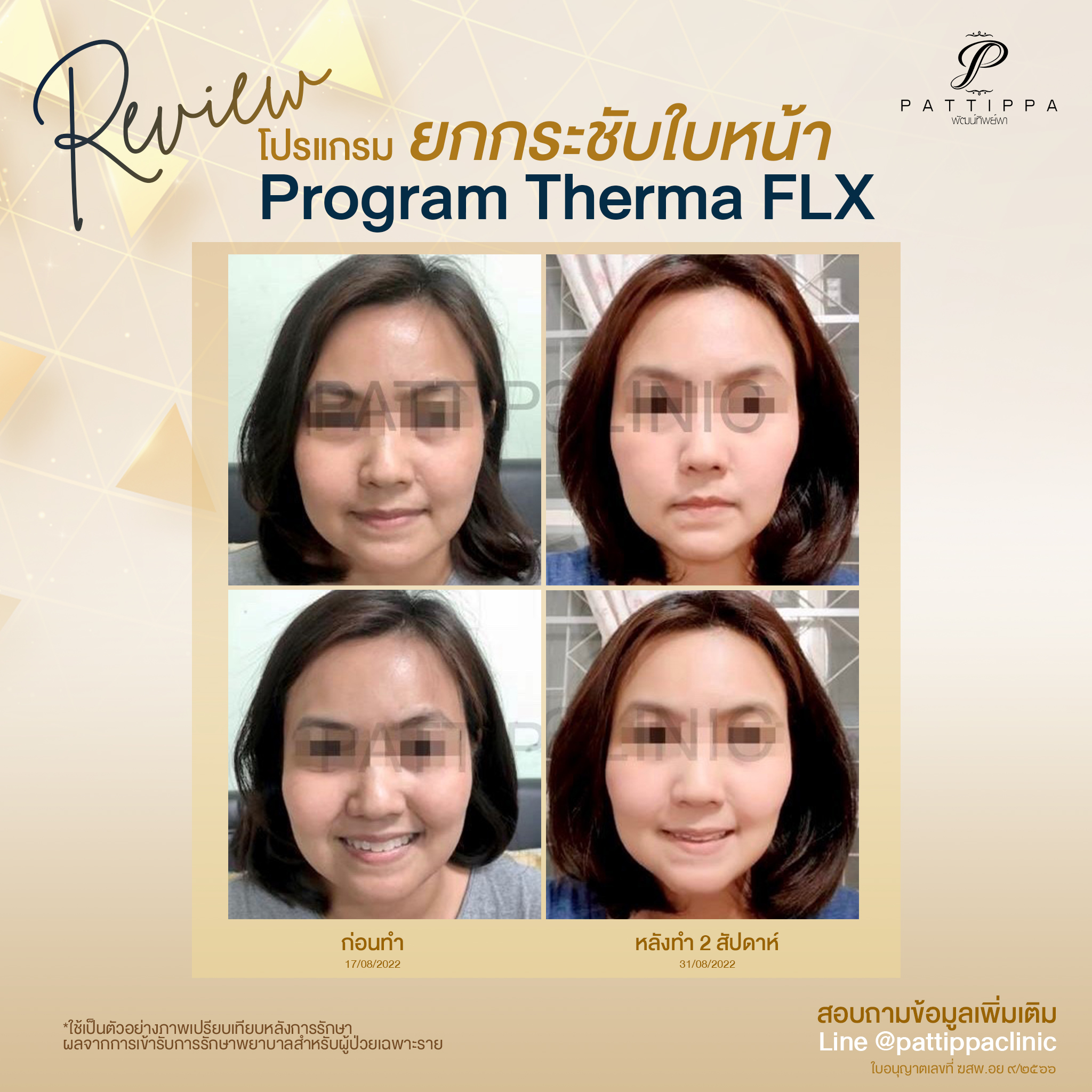 Patt_review_thermage_001-3