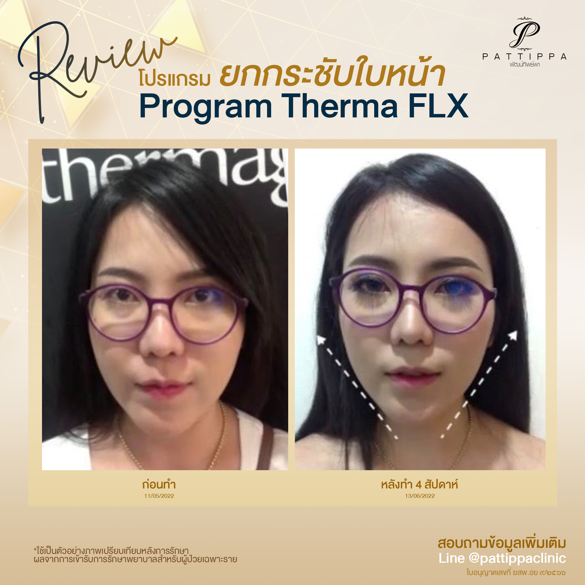 Patt_review_thermage_001-4