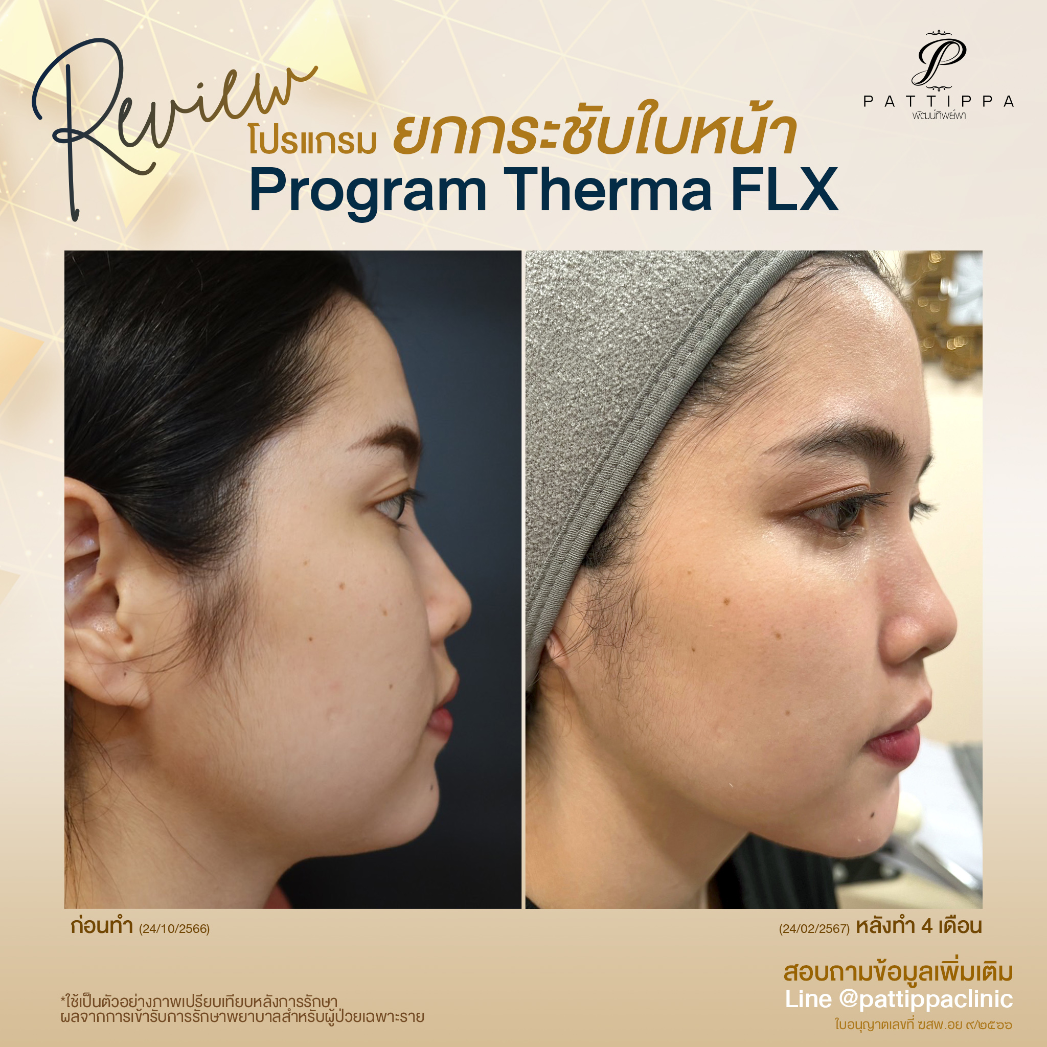 Patt_review_thermage_002-1