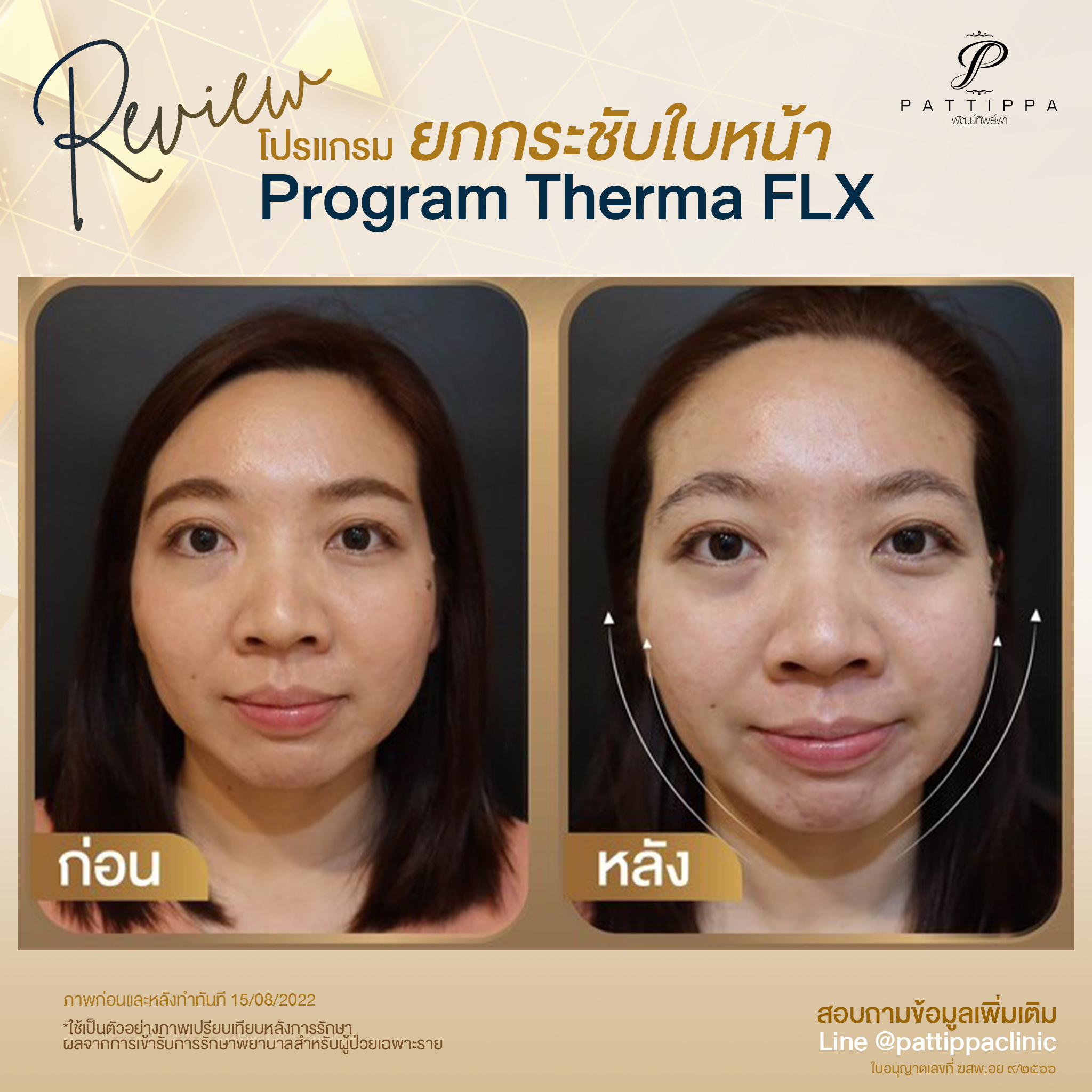 Patt_review_thermage_003-1