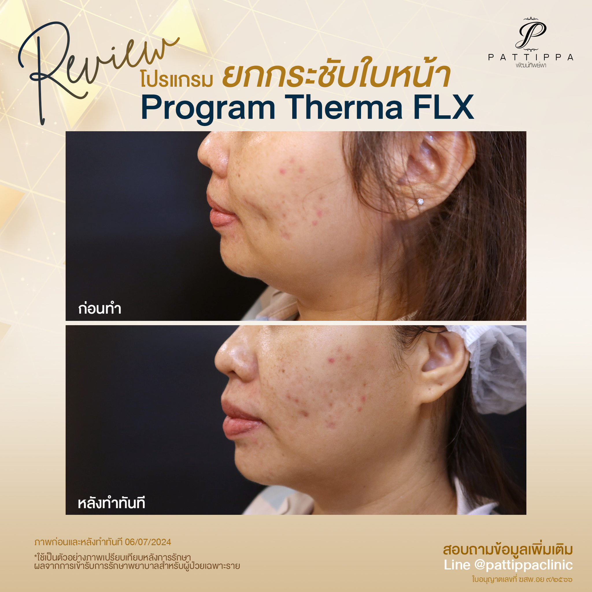 Patt_review_thermage_005