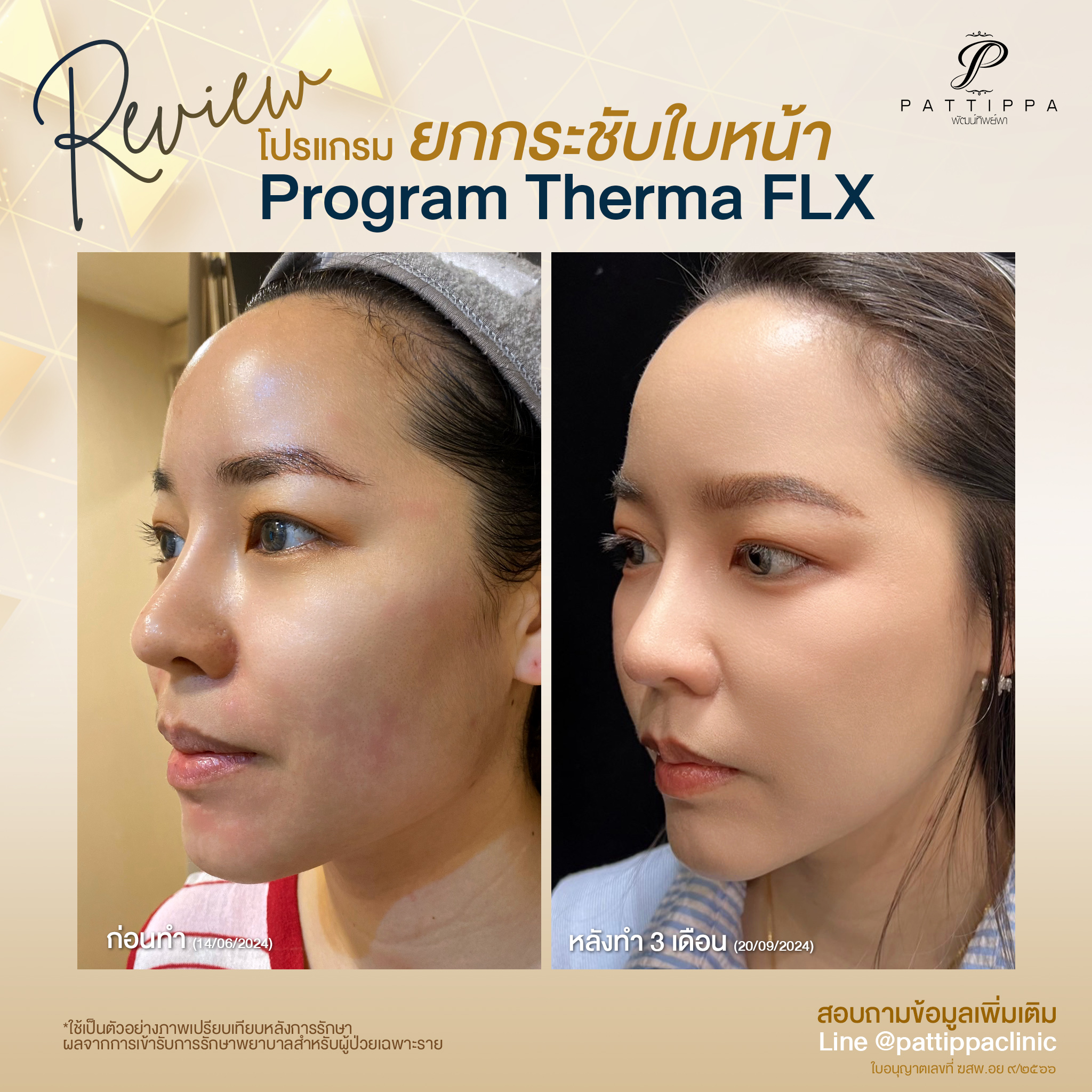 Patt_review_thermage_006-1