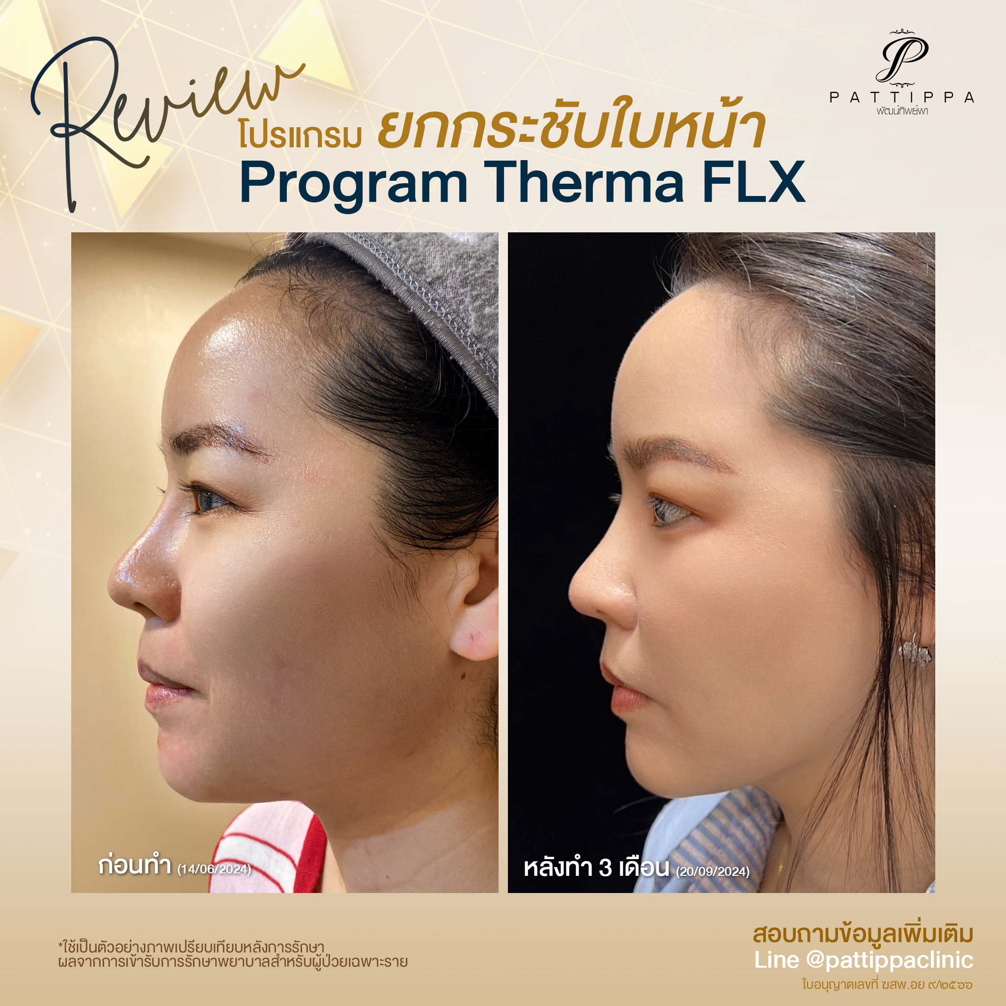 Patt_review_thermage_006-2