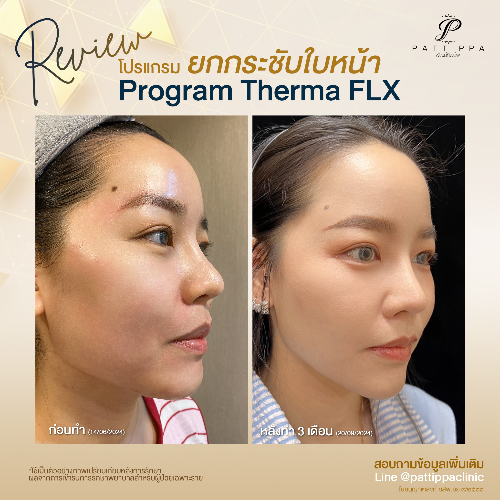 Patt_review_thermage_006-3