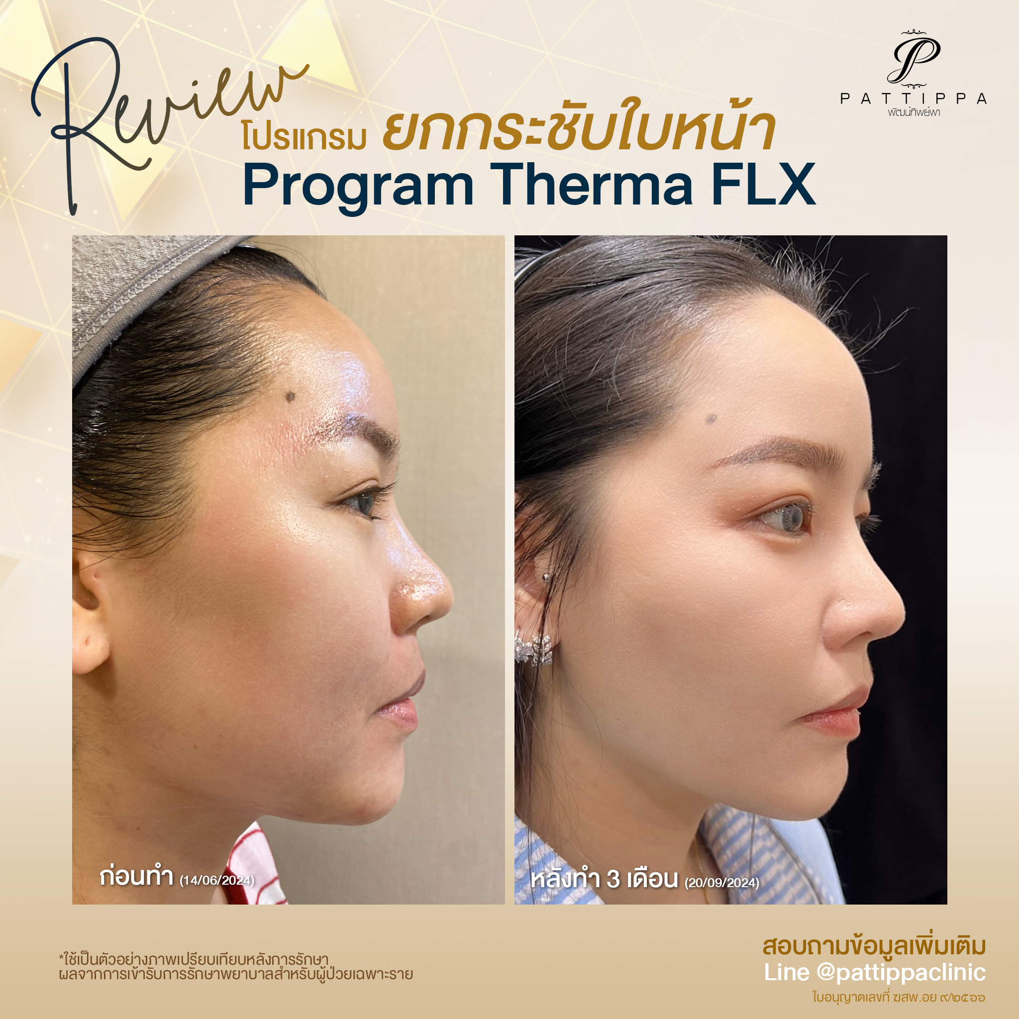 Patt_review_thermage_006-4