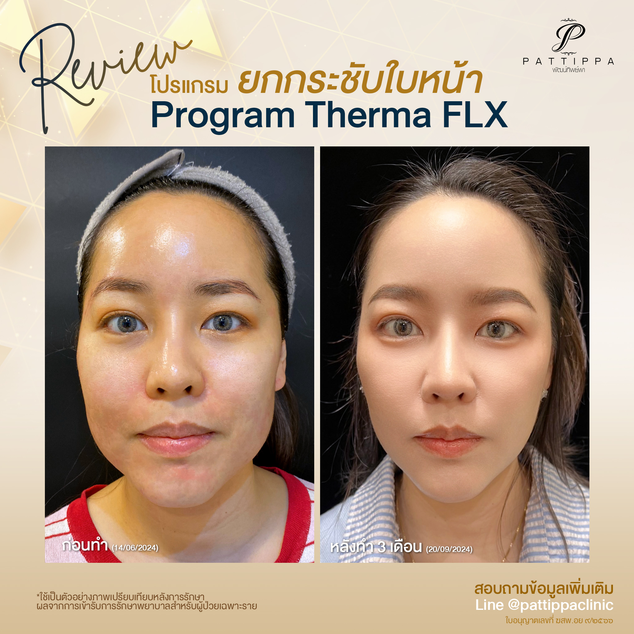 Patt_review_thermage_006