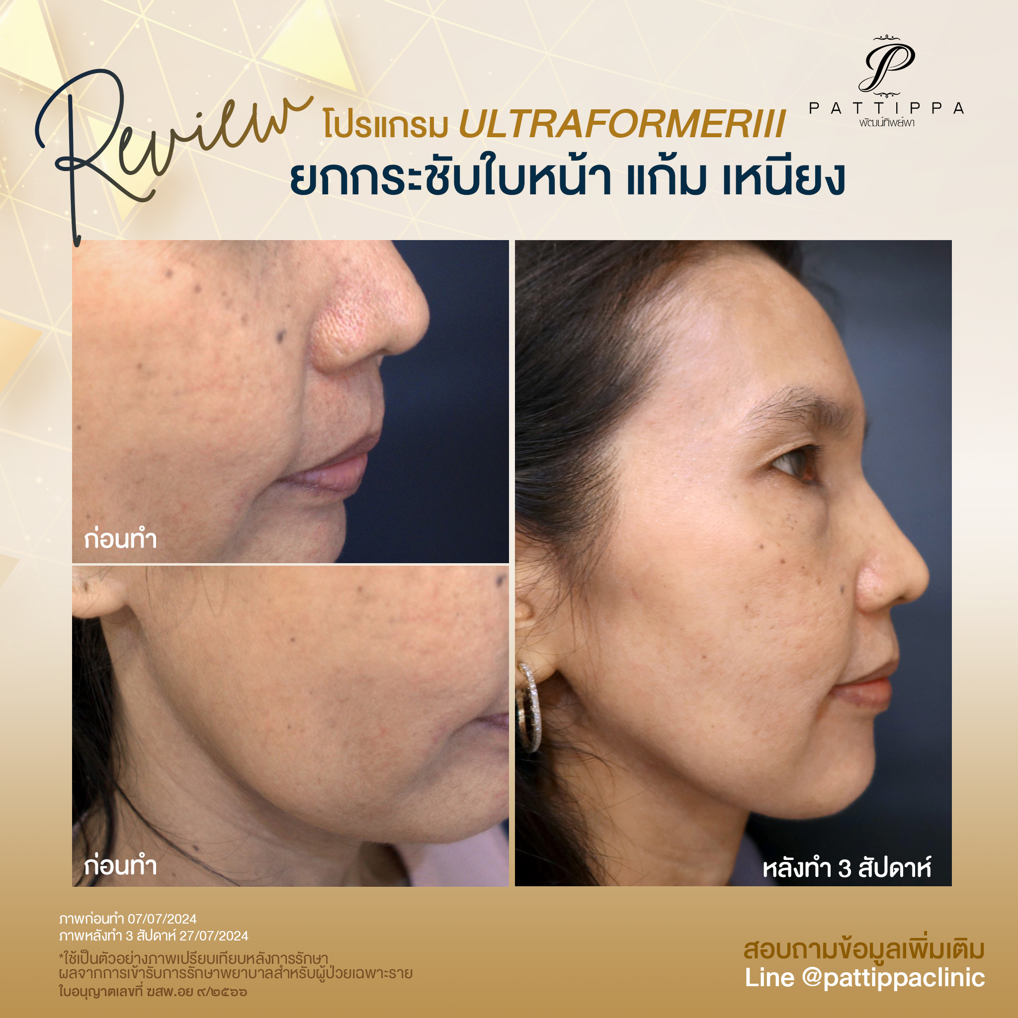 Patt_review_ultraformer3_004