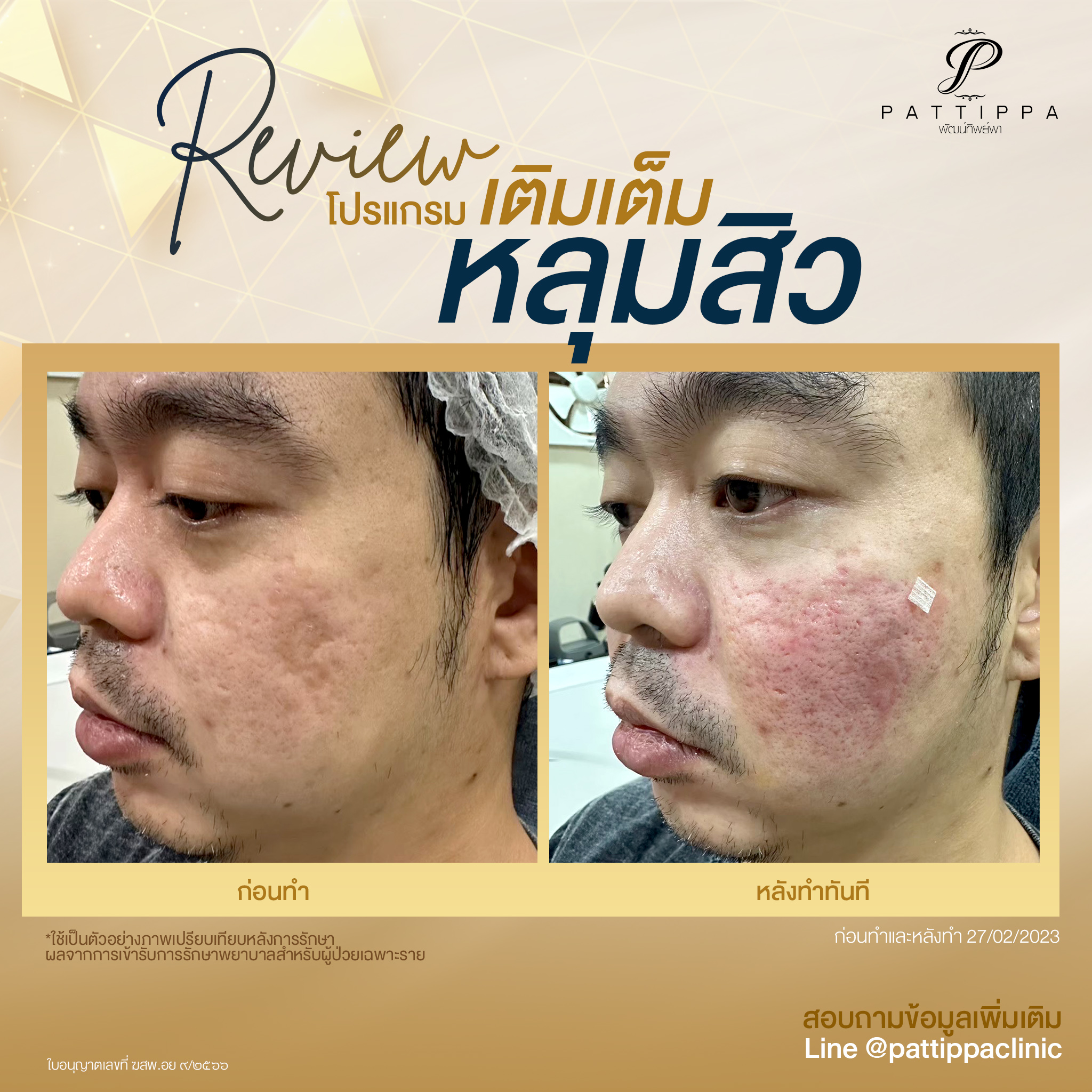 Patt_review_filler-acnescar_001-1