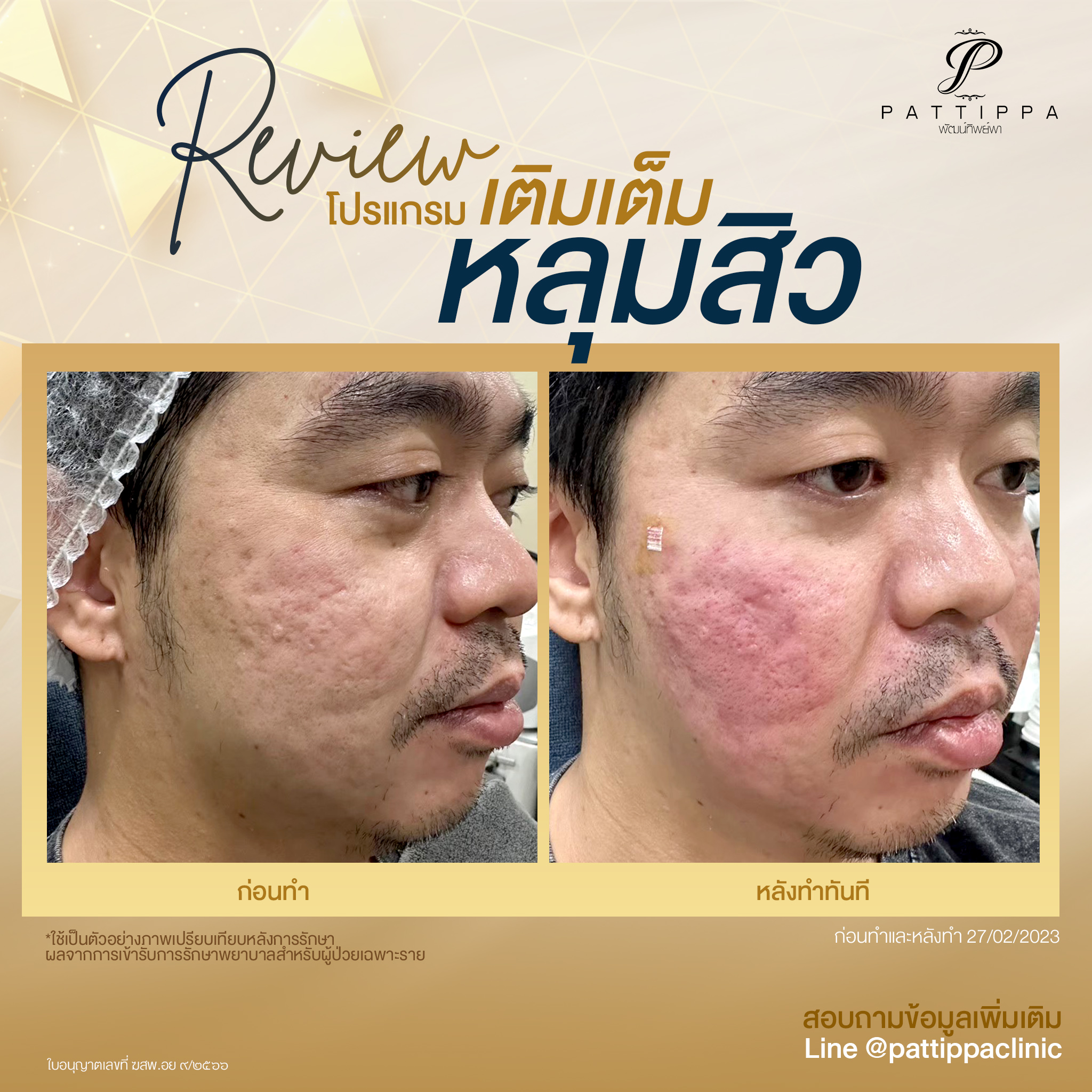 Patt_review_filler-acnescar_001