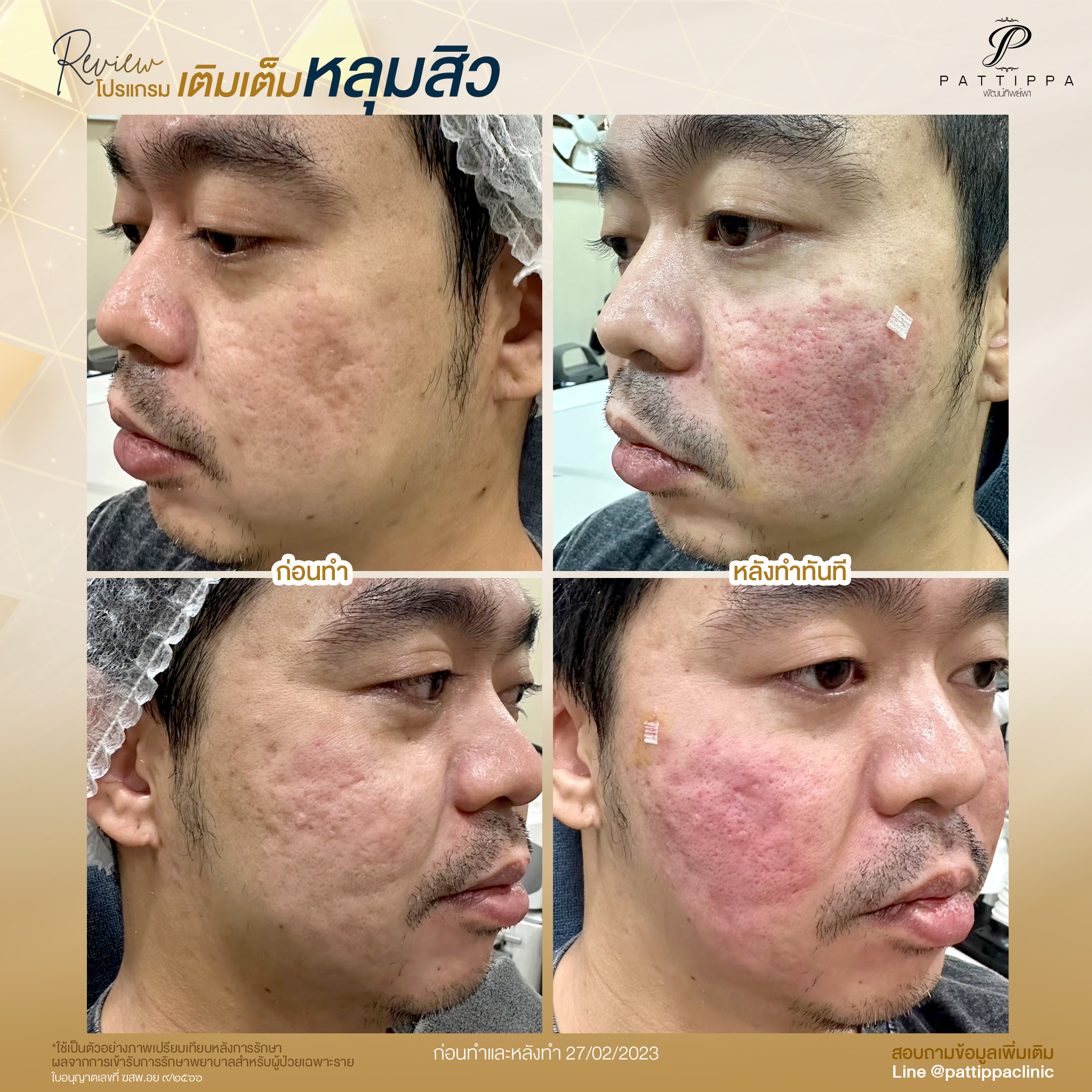 Patt_review_filler-acnescar_002