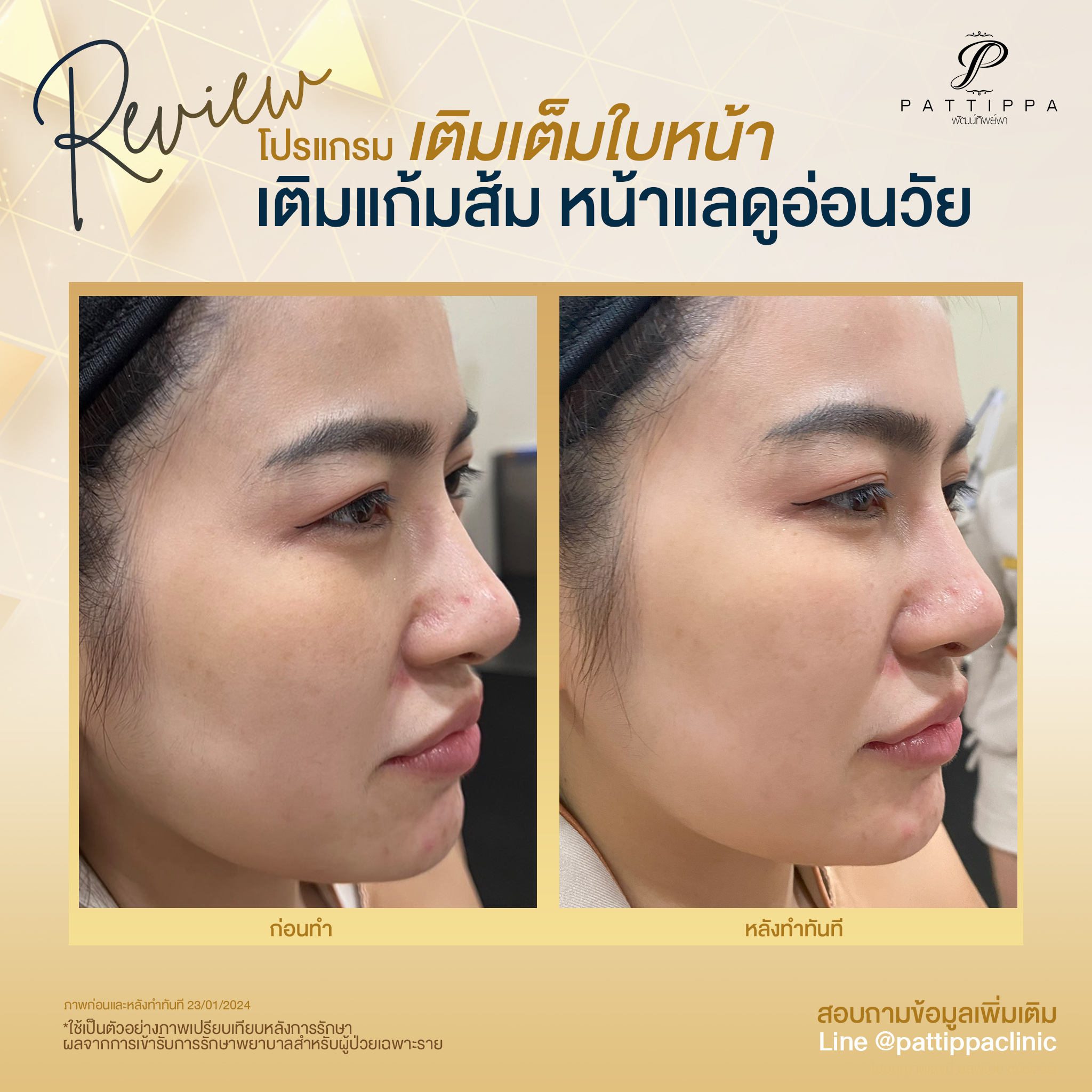 Patt_review_filler-cheek_002-1