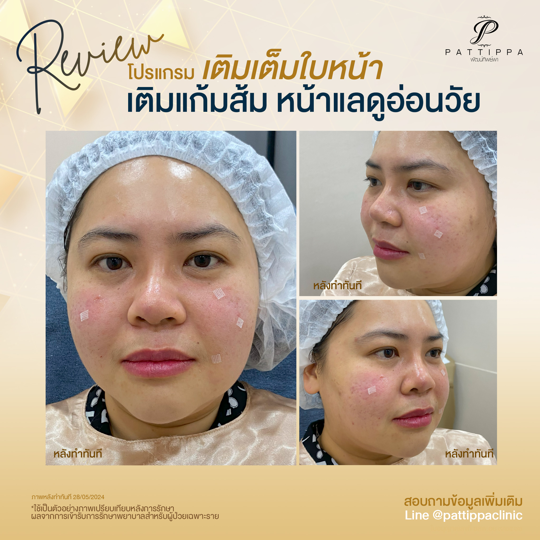 Patt_review_filler-cheek_003