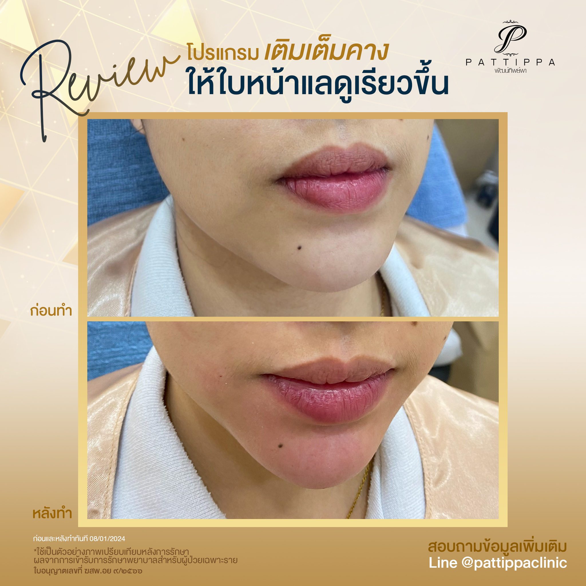 Patt_review_filler-chin_001