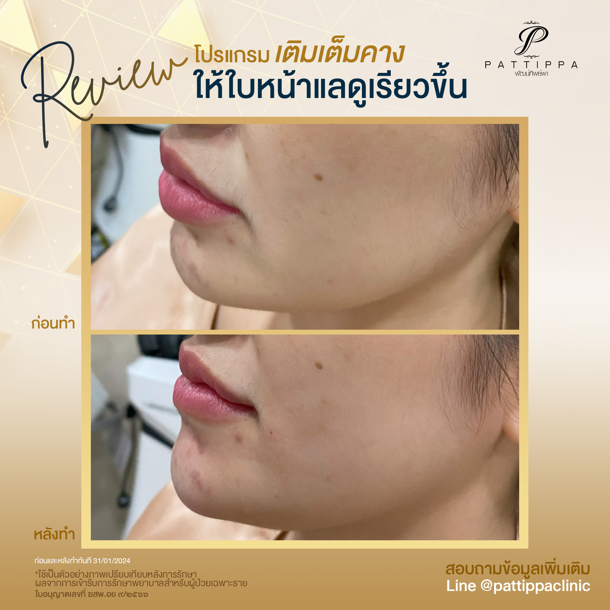 Patt_review_filler-chin_002-1