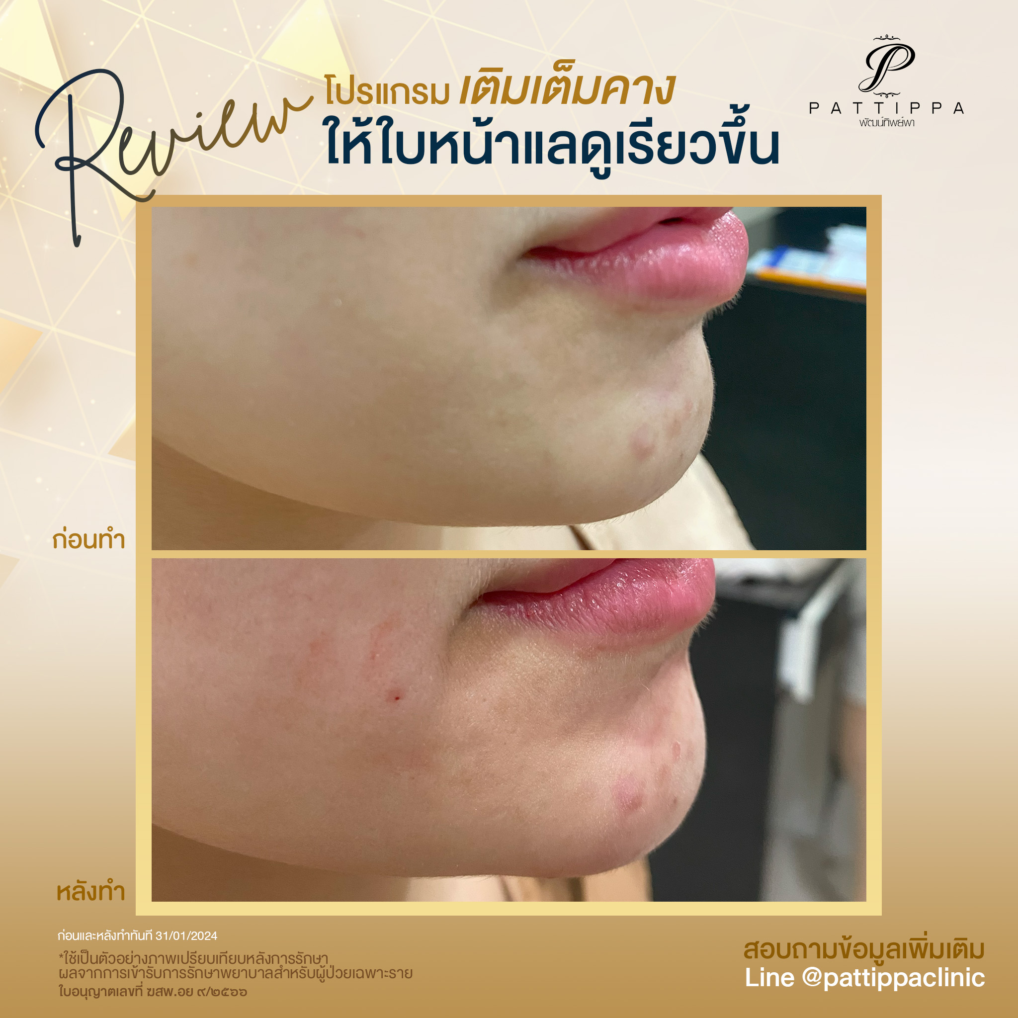 Patt_review_filler-chin_002