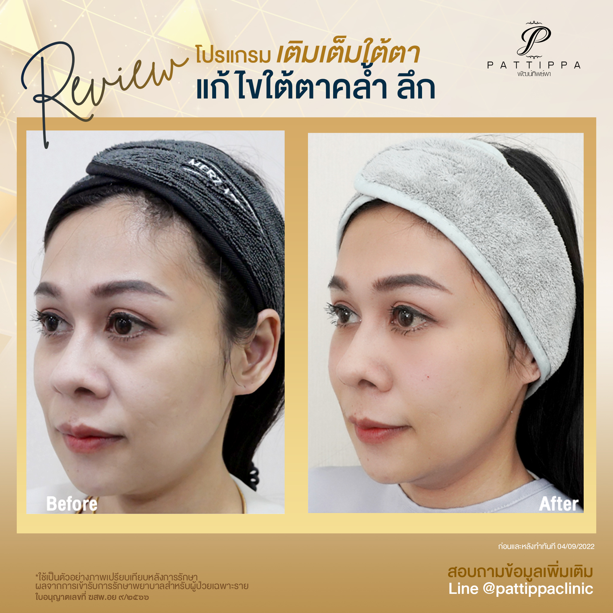 Patt_review_filler-eye_006