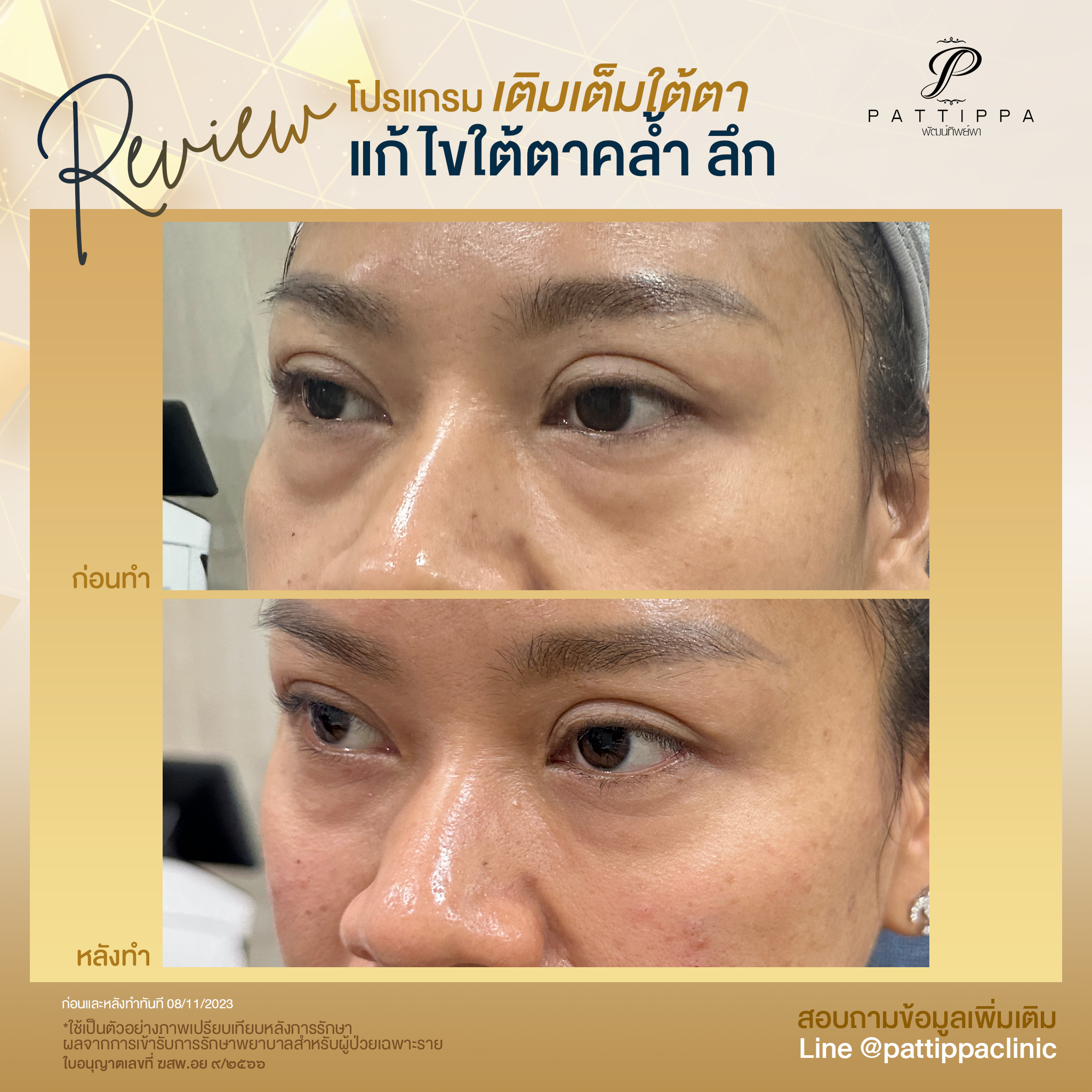 Patt_review_filler-eye_007-2