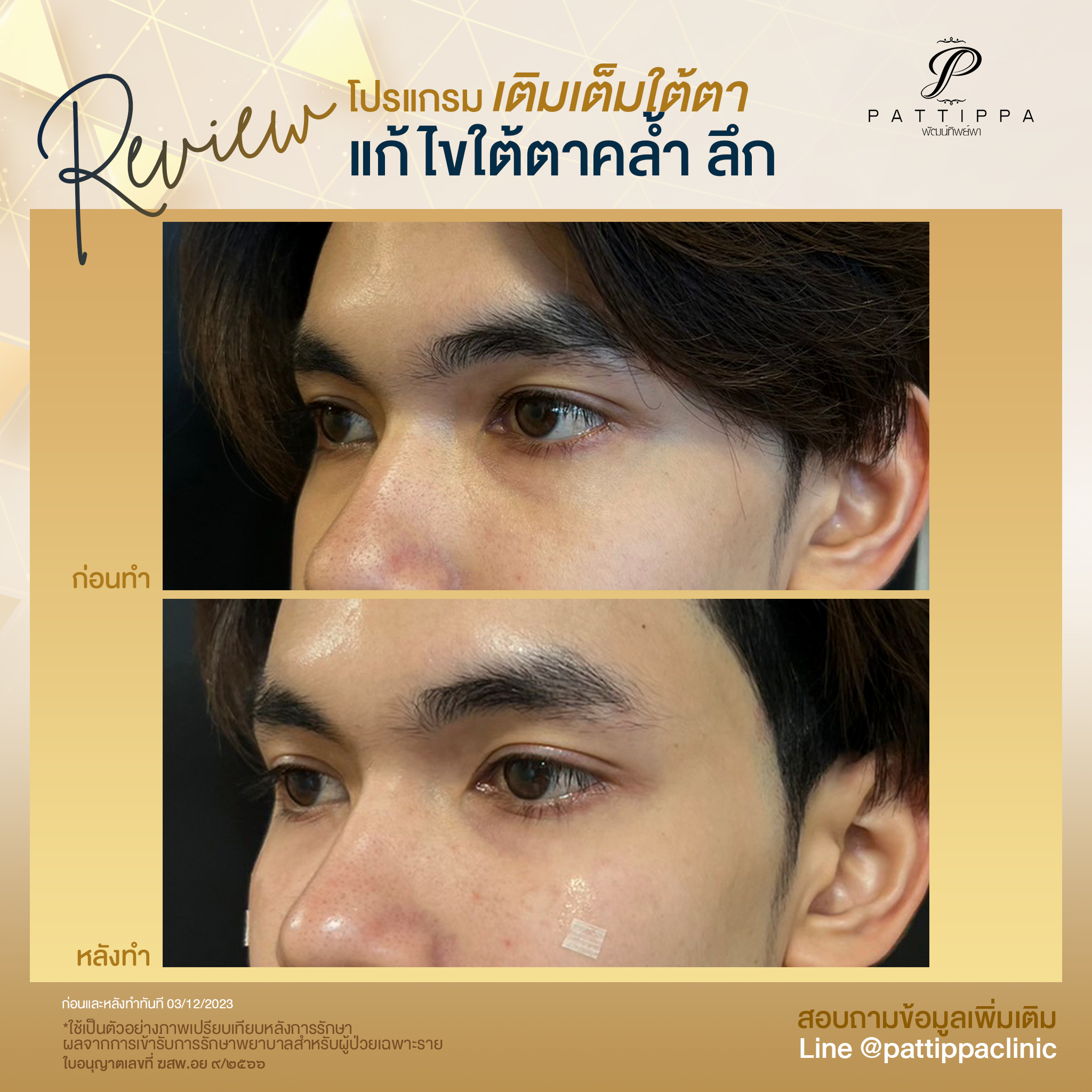 Patt_review_filler-eye_007-3