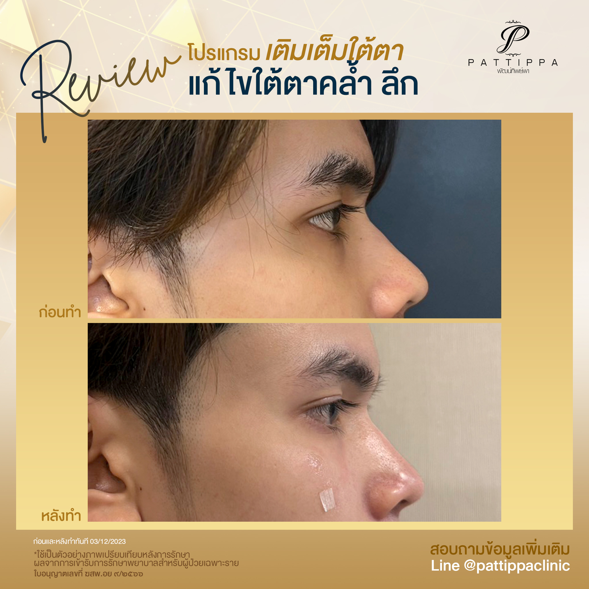 Patt_review_filler-eye_007-4