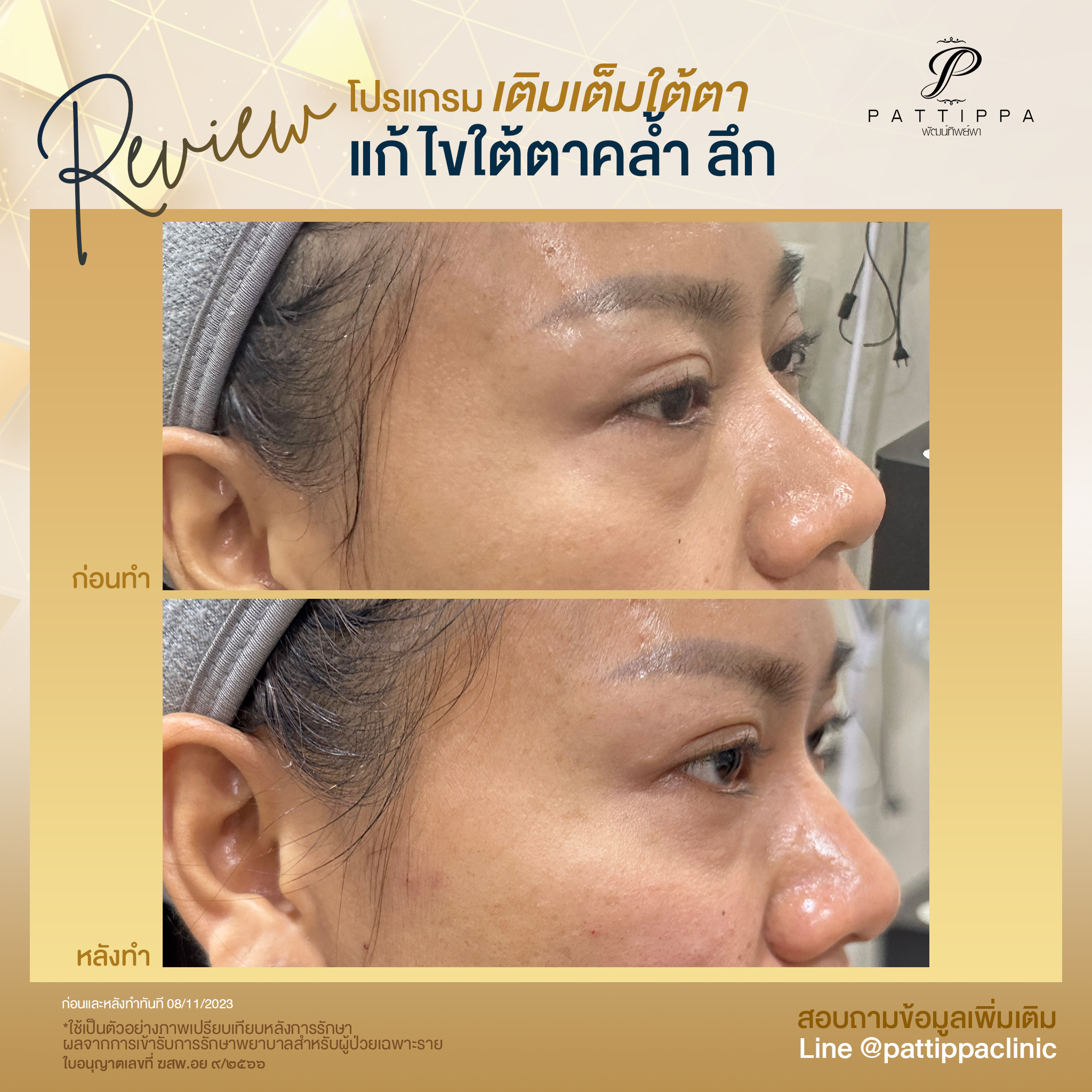 Patt_review_filler-eye_007