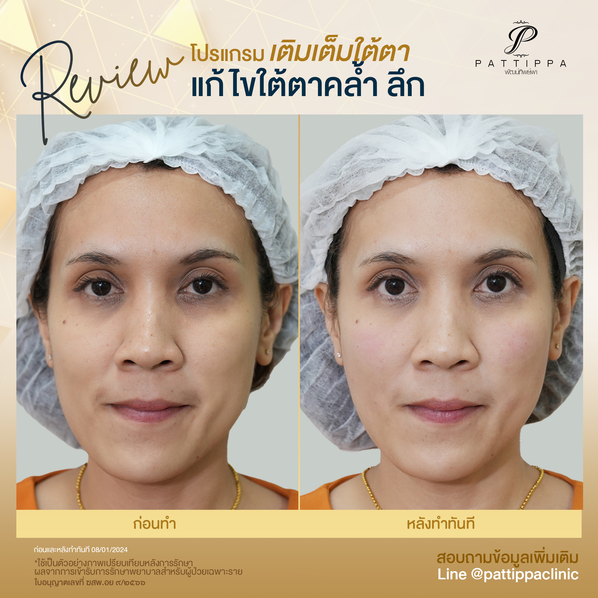 Patt_review_filler-eye_008