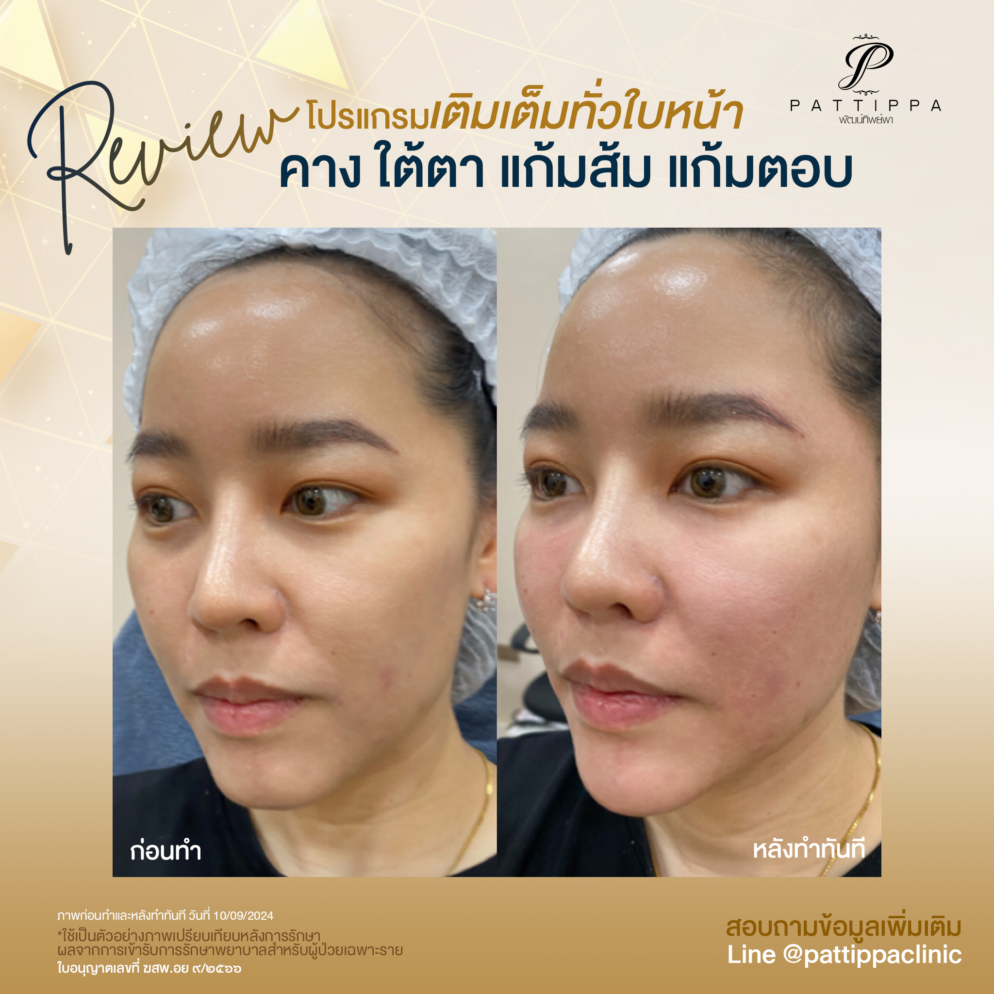 Patt_review_filler-face_017