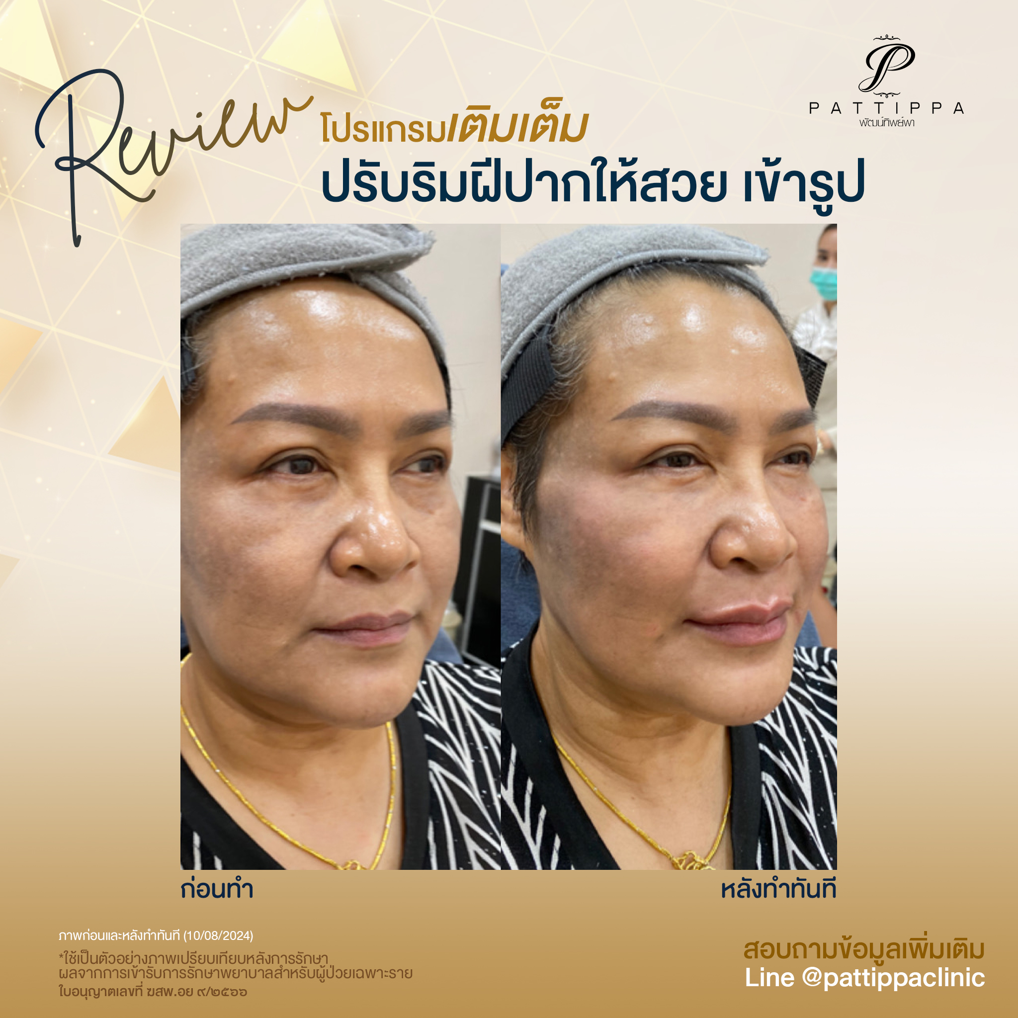 Patt_review_filler-lip_006-1