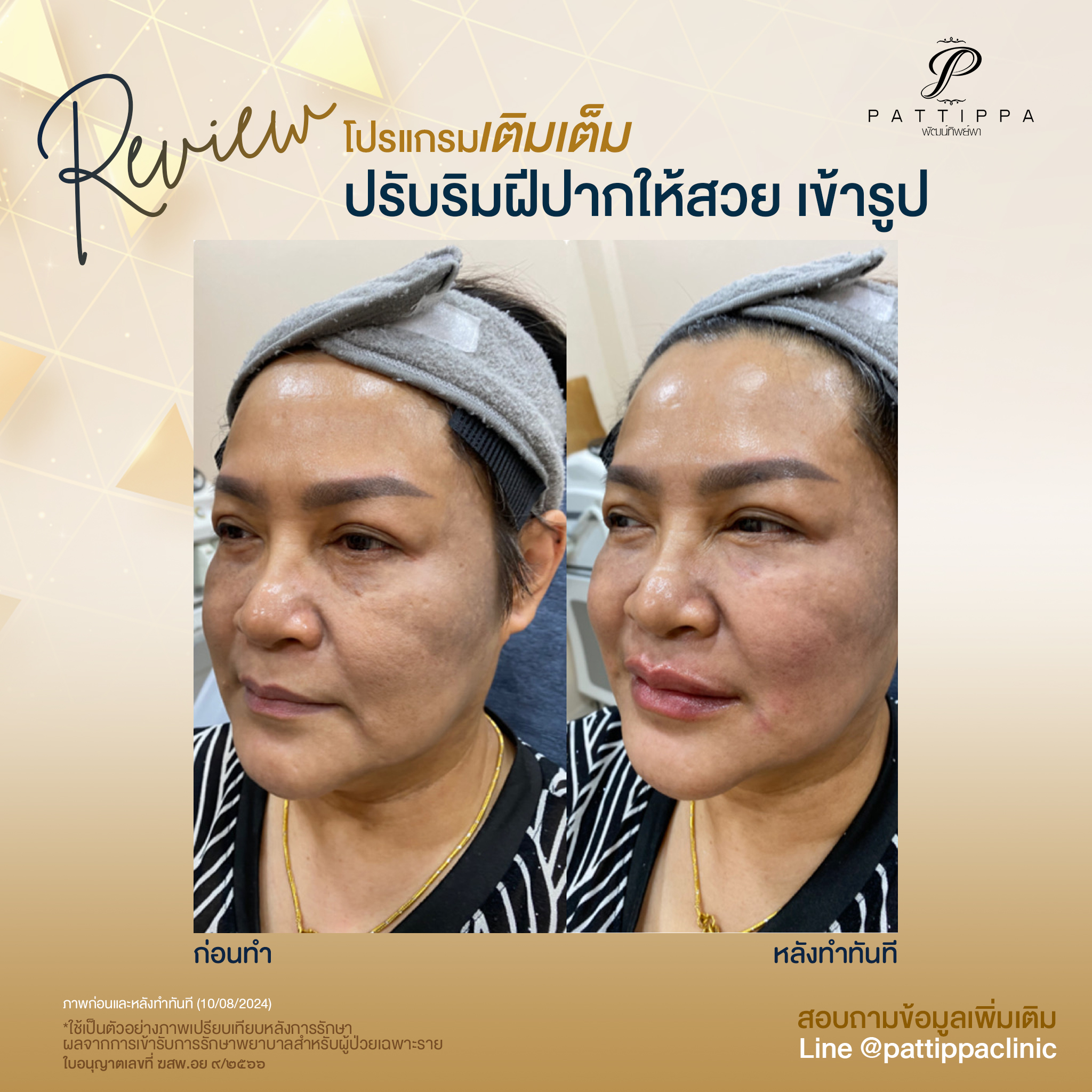 Patt_review_filler-lip_006-2