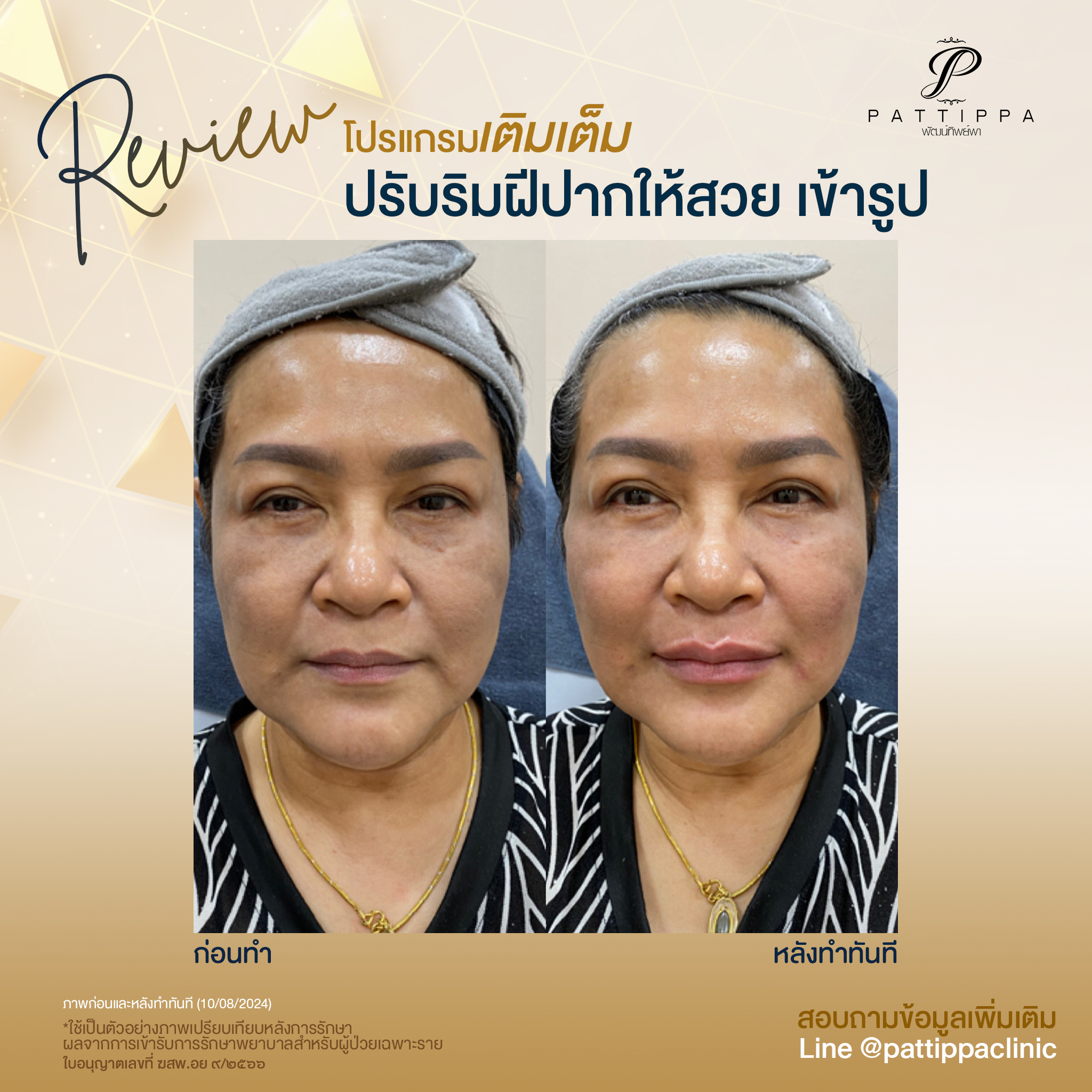 Patt_review_filler-lip_006