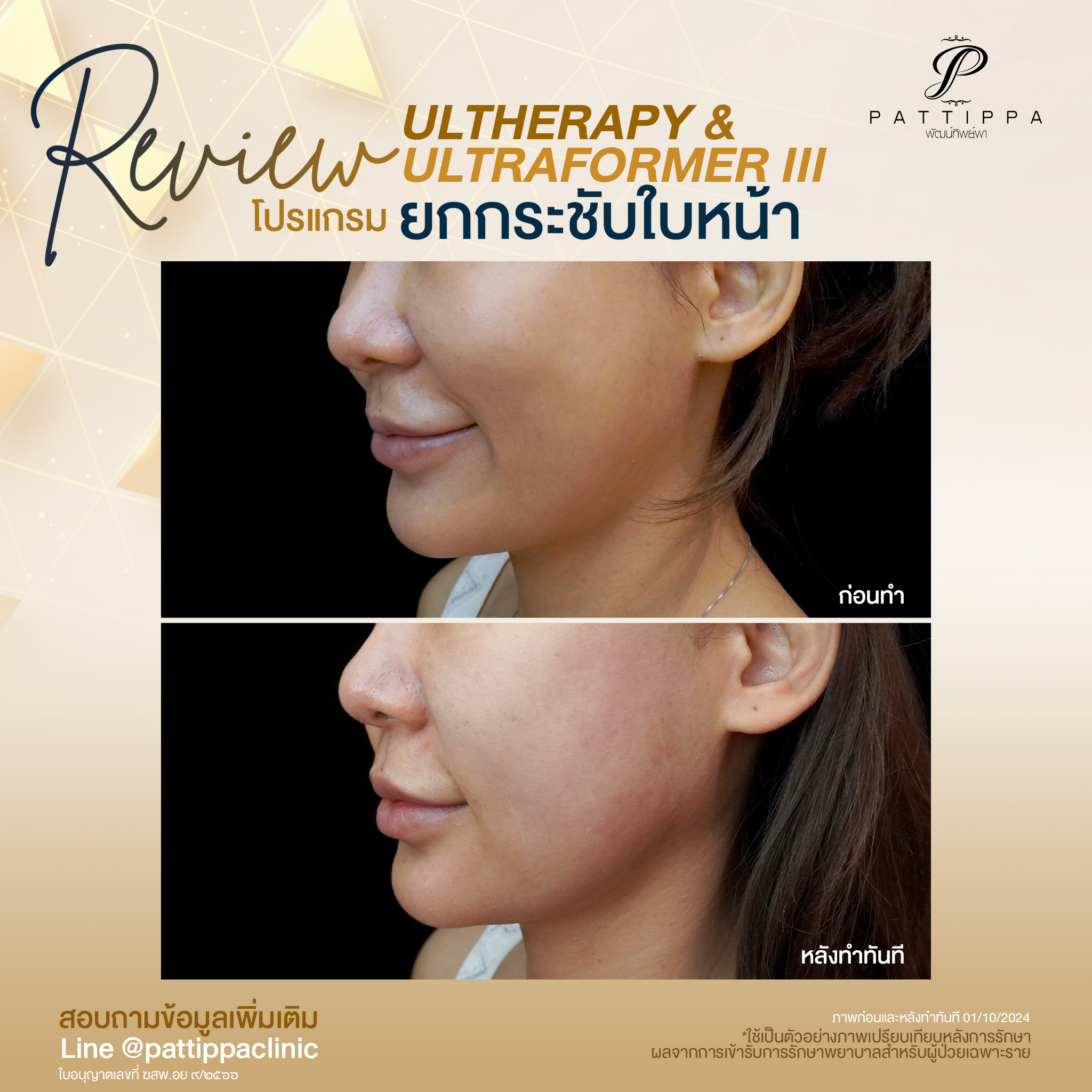 Patt_review_ultherapy+ultraformer3_006