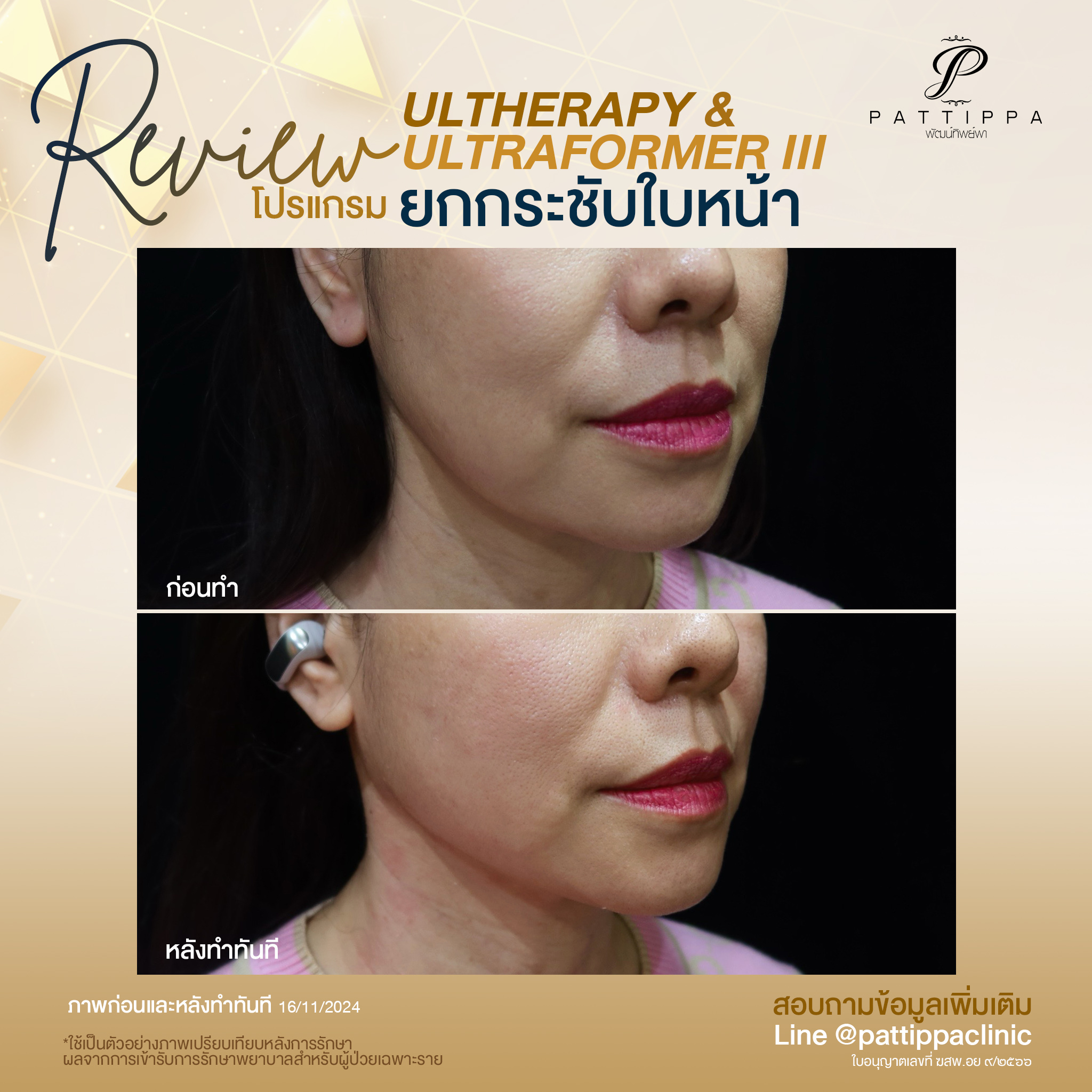 Patt_review_ultherapy+ultraformer3_008-1
