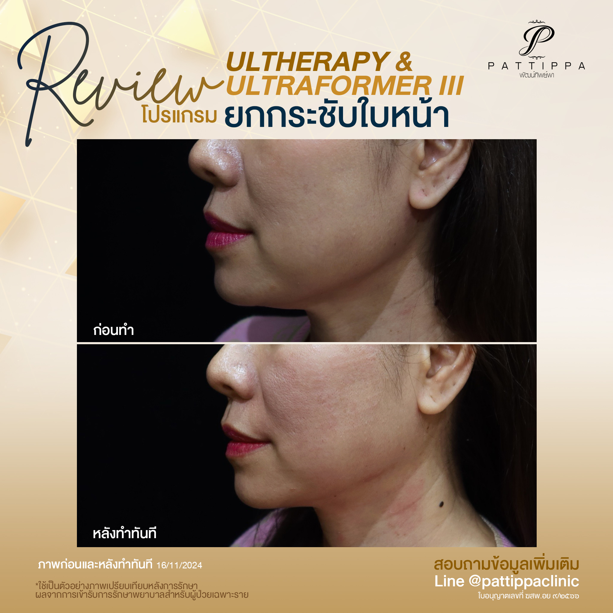 Patt_review_ultherapy+ultraformer3_008