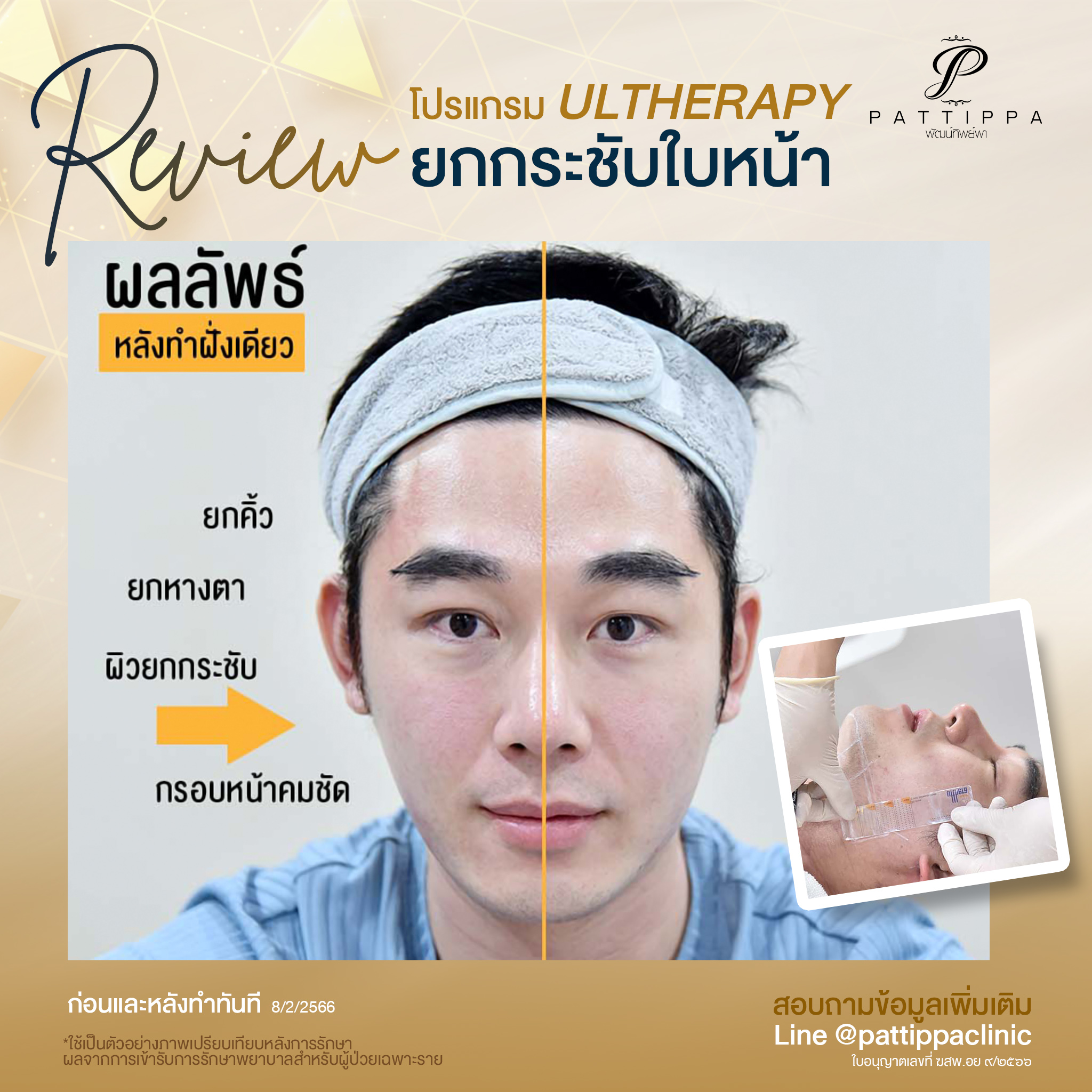 Patt_review_filler-ulthera_002