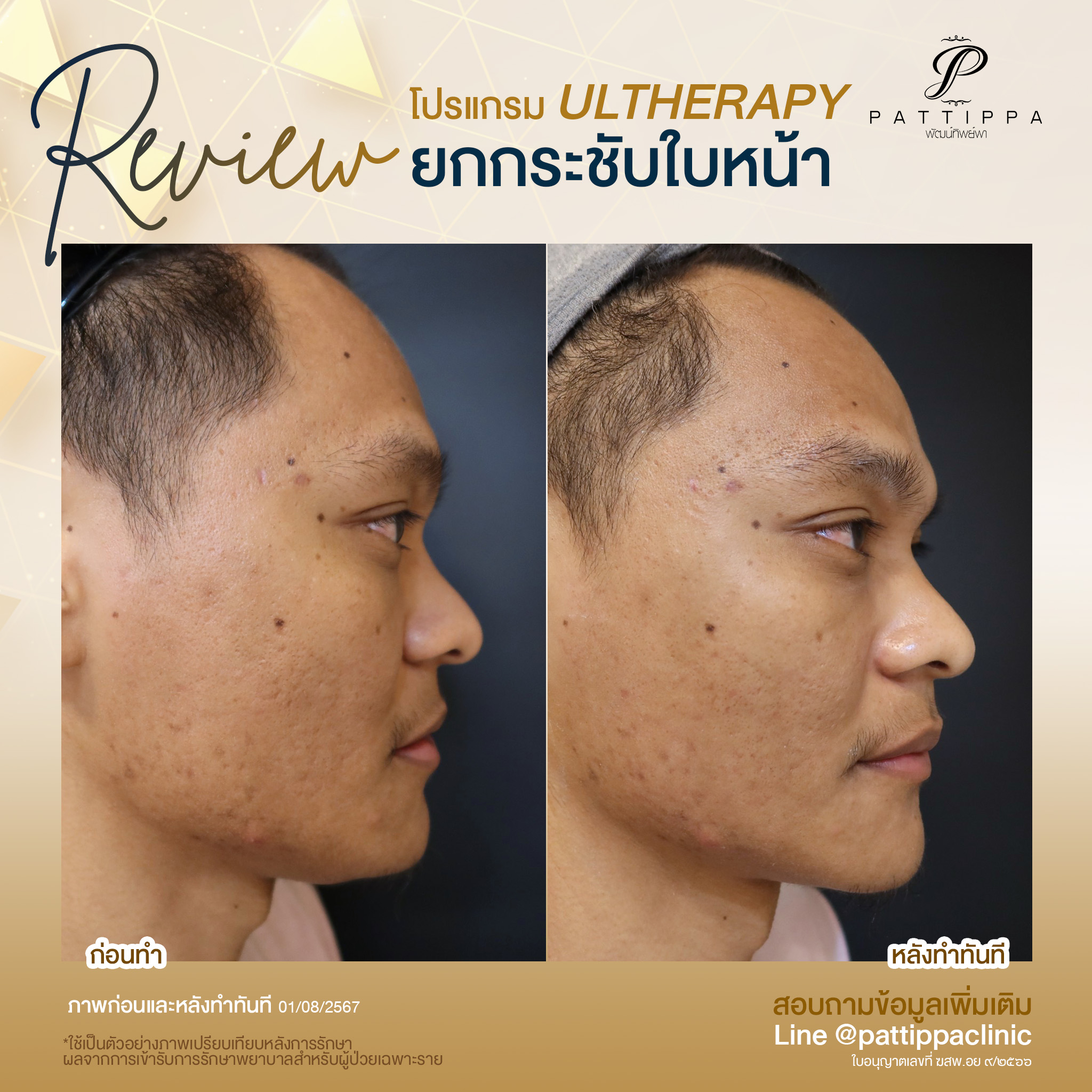 Patt_review_filler-ulthera_006