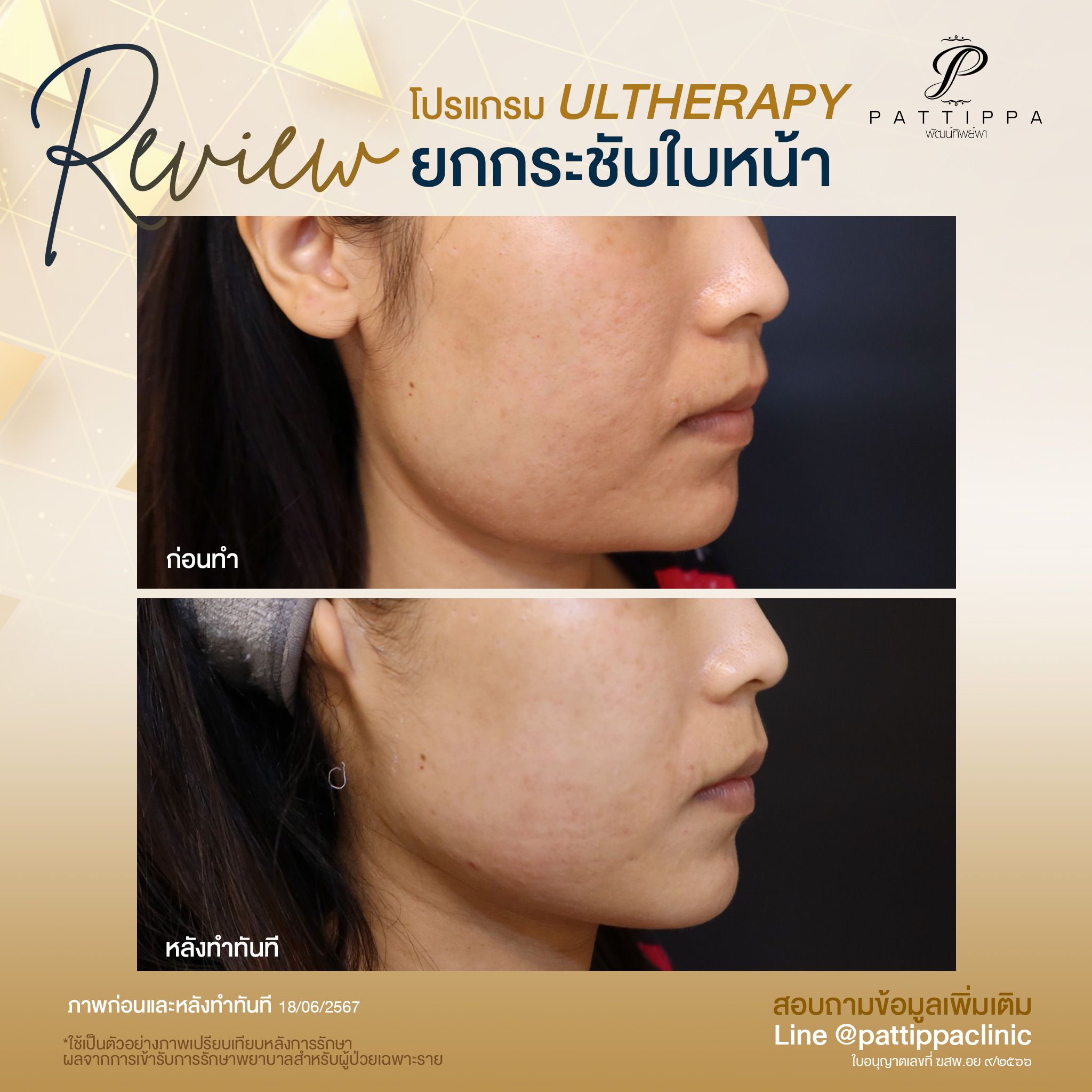 Patt_review_filler-ulthera_010