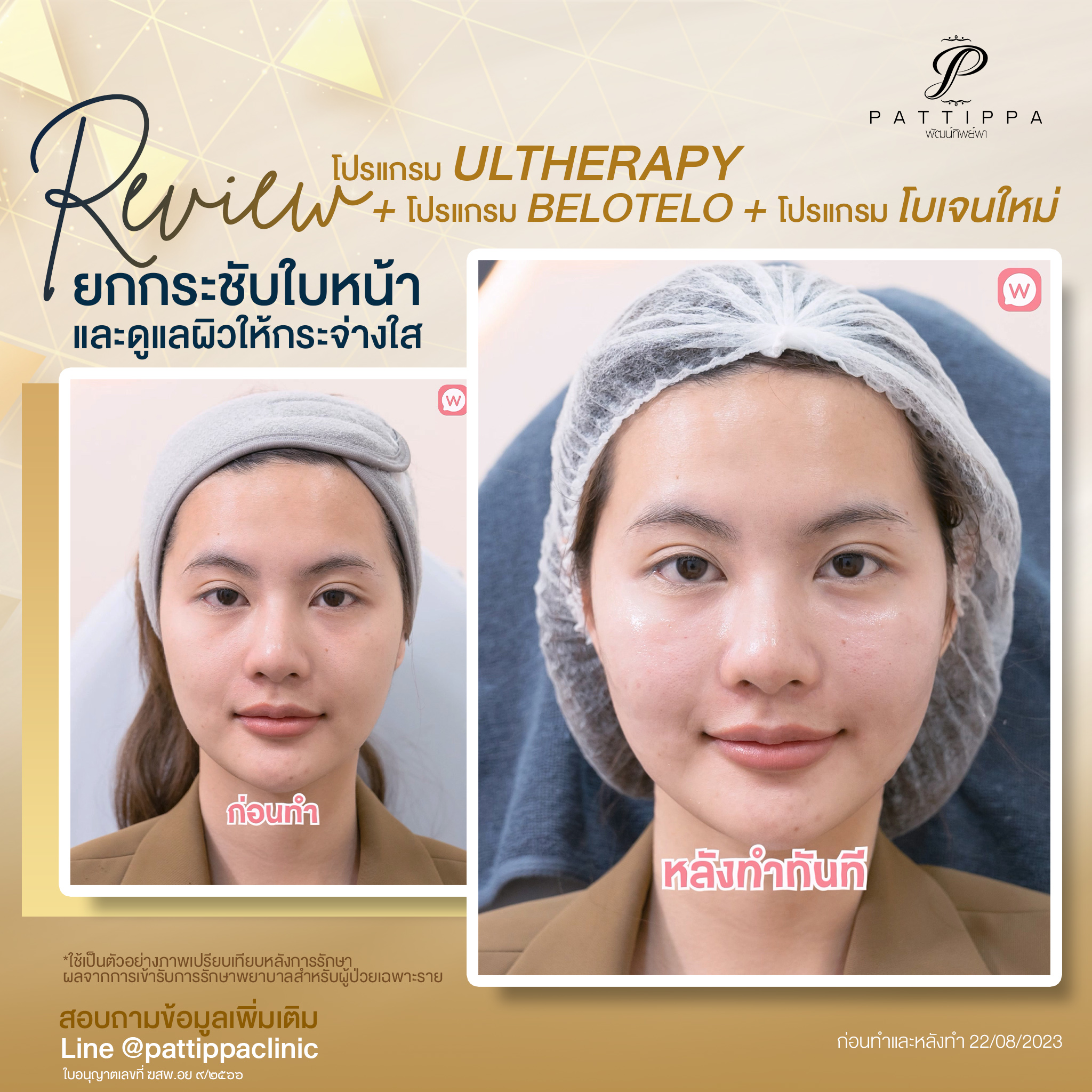 Patt_review_ulthera-wongnai_001