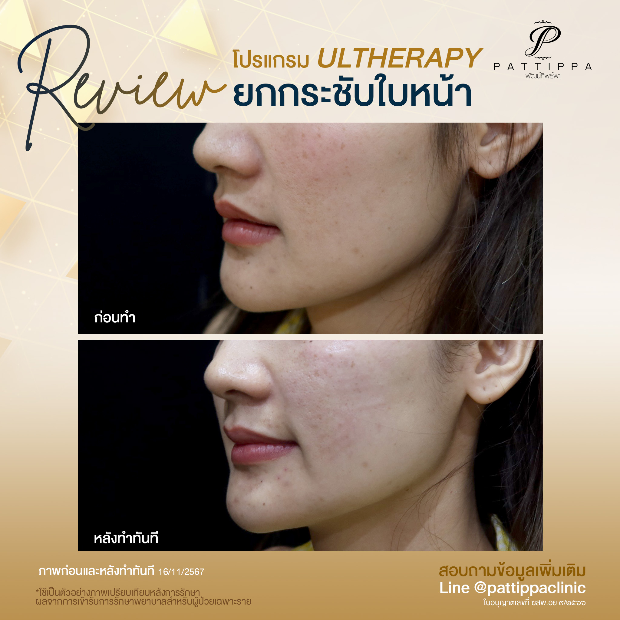 Patt_review_ulthera_011