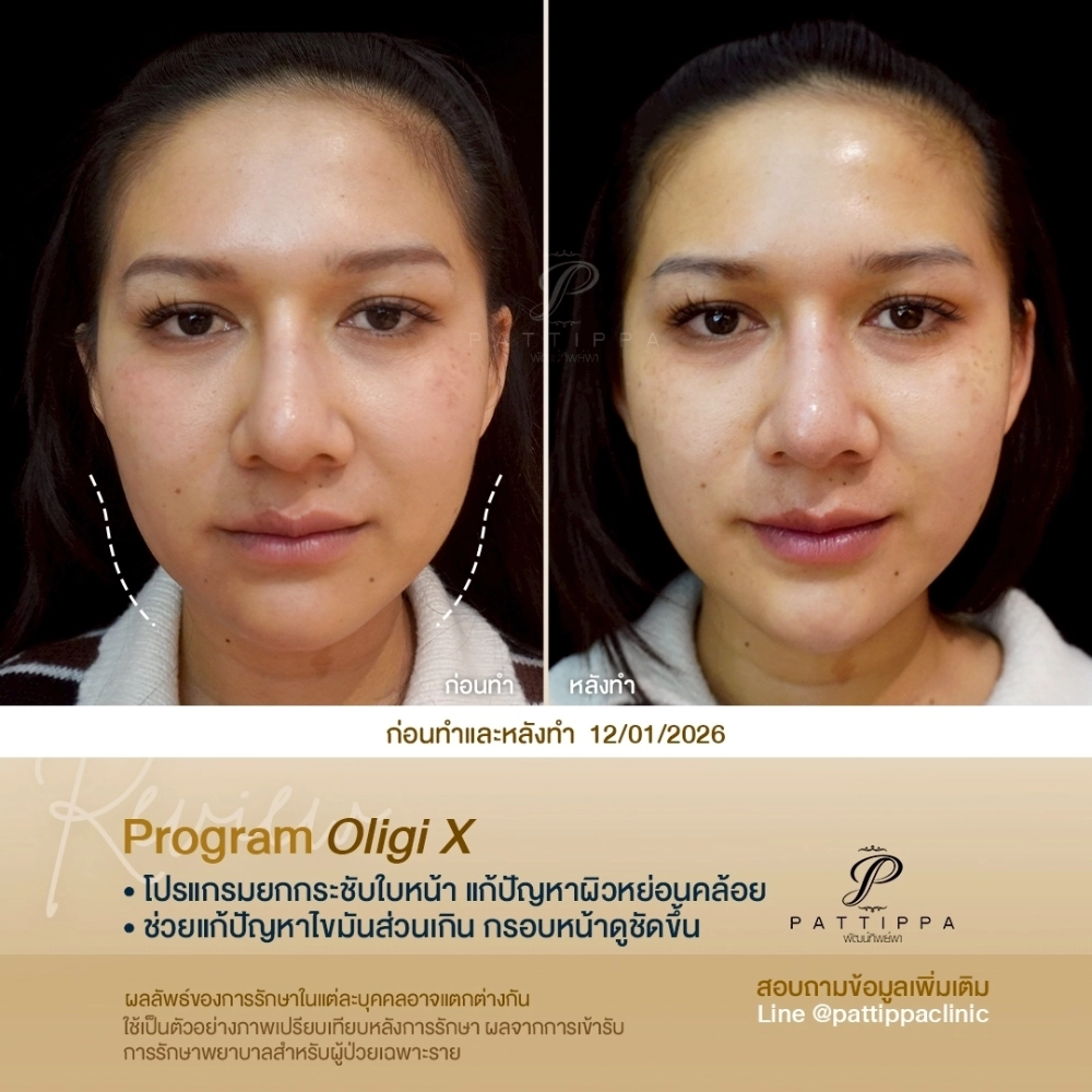รีวิว โปรแกรม OligioX